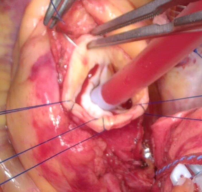 My bicuspid aortic valve. Dr. stelzer just sent pictures from my surgery. So wild to see his work and my actual heart.