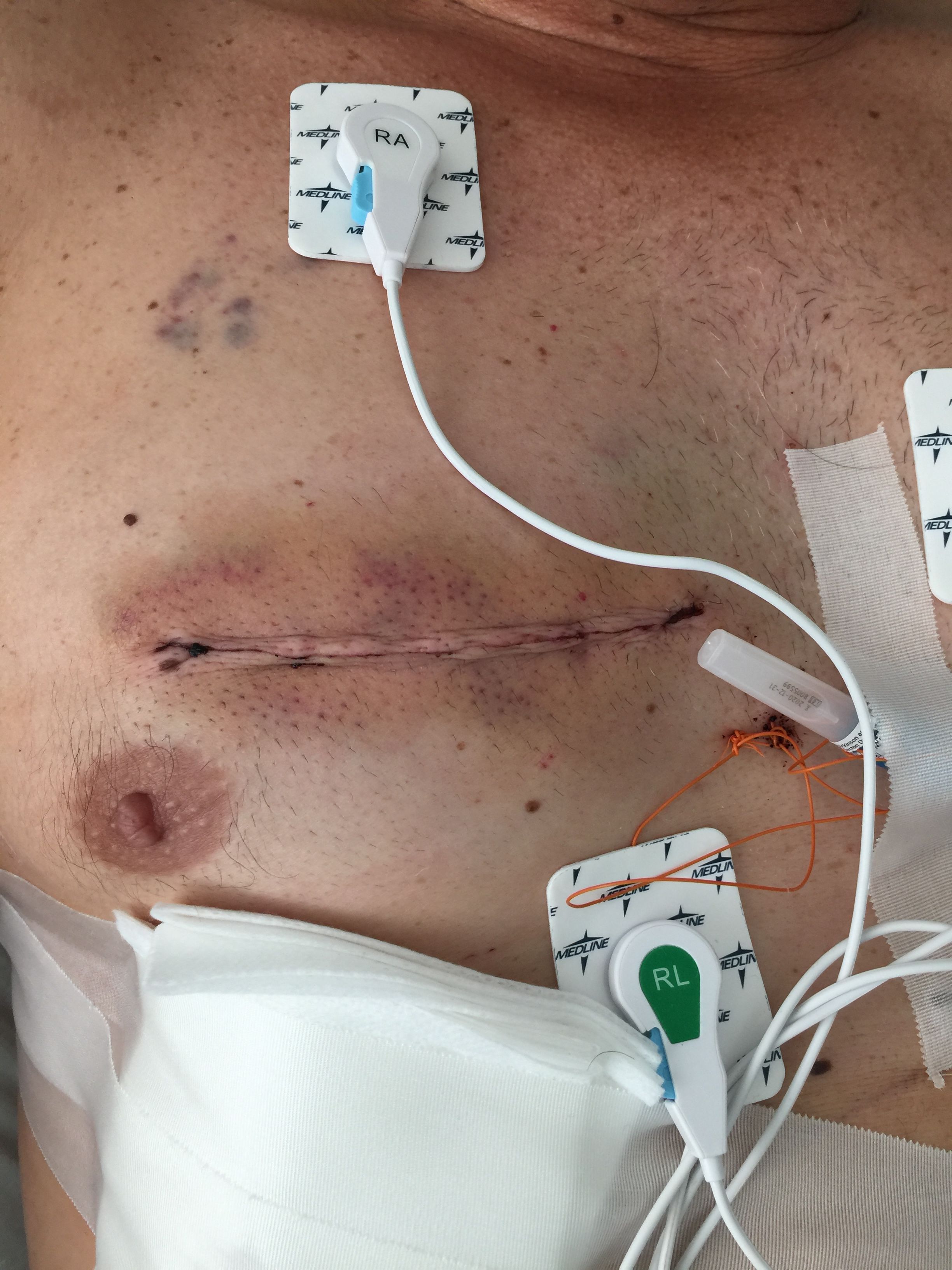Post-op 4
Mini Thoracotomy. Incision healing well.
Excellent work done by Dr . Michael RosenBloom