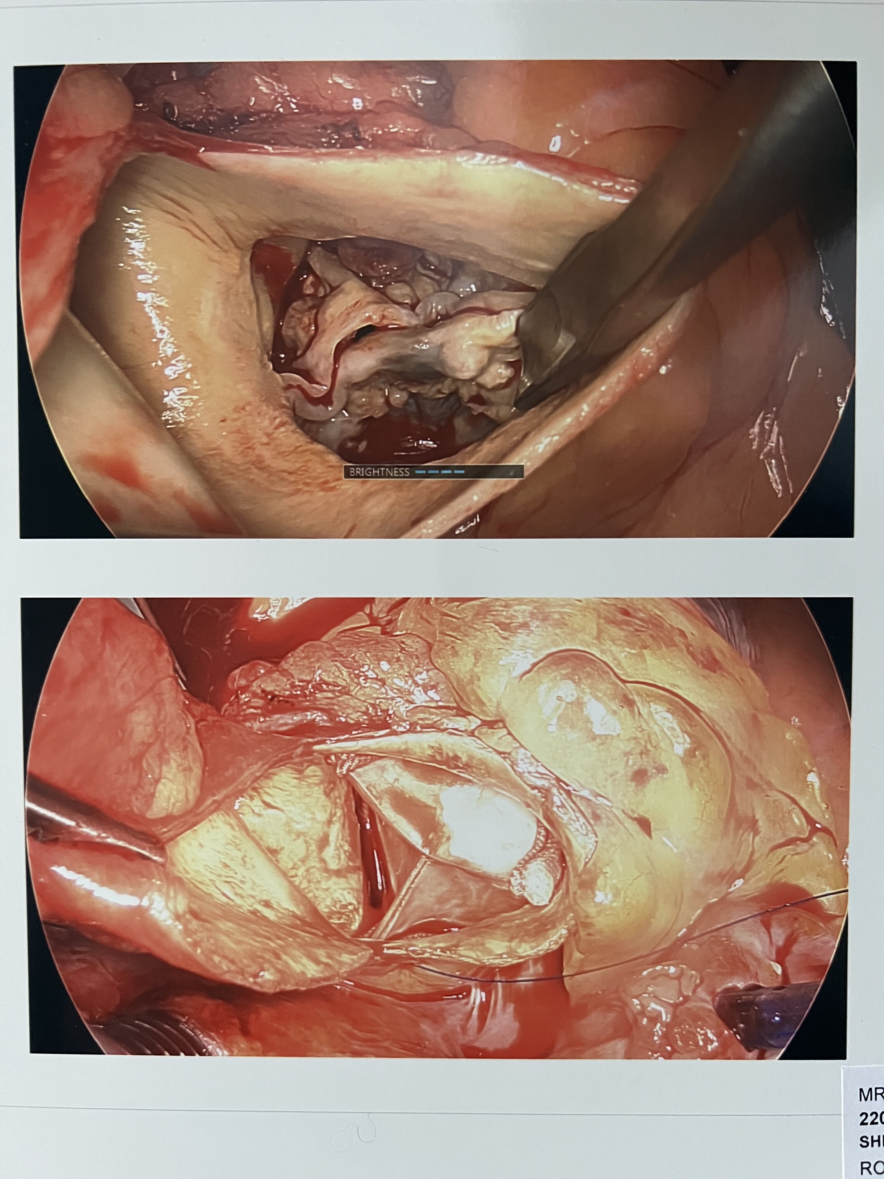 One week ago today (Dec 10, 2021) I had my ðŸ«€ SAVR surgery to replace my aortic valve along with an Ablation to correct the side issue of Afib and fix a cuspid anomaly!

Top image shows bicuspid valve in Severe Aortic Stenosis taken by surgeon during