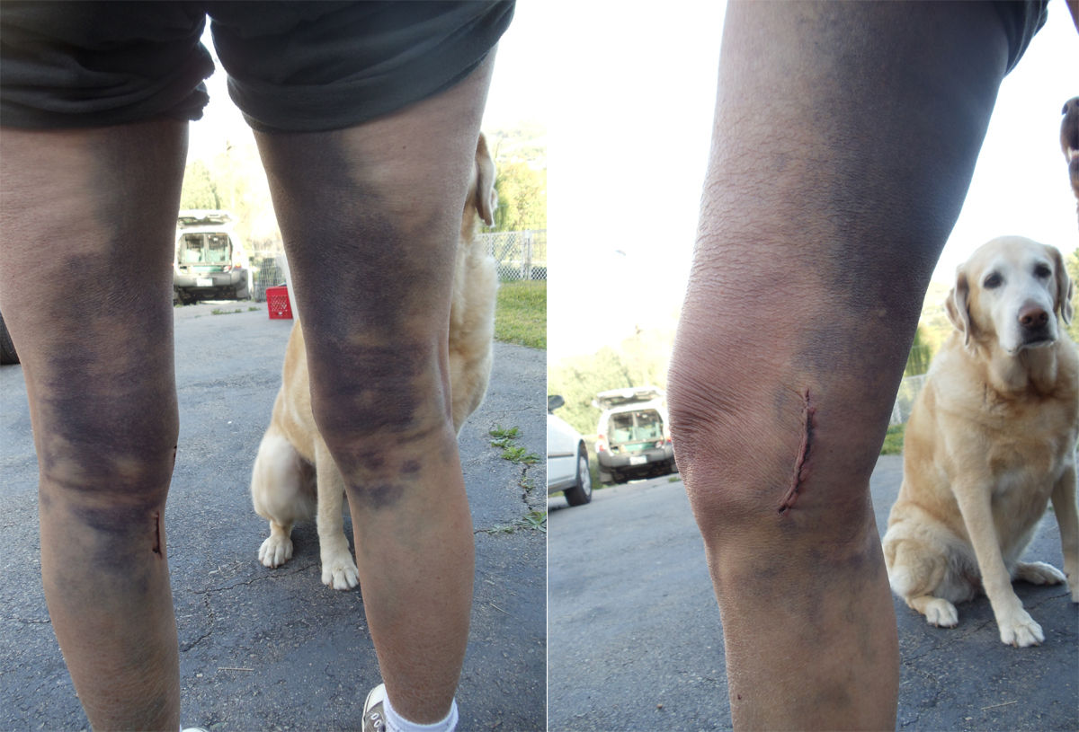 Bruises - vein stripping for quad bypass