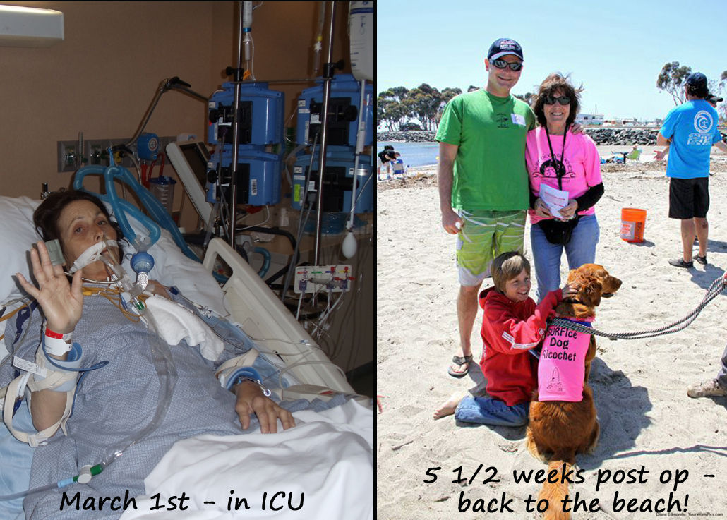Before & After 5 1/2 weeks post op