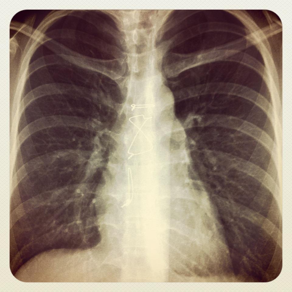 sternum wires