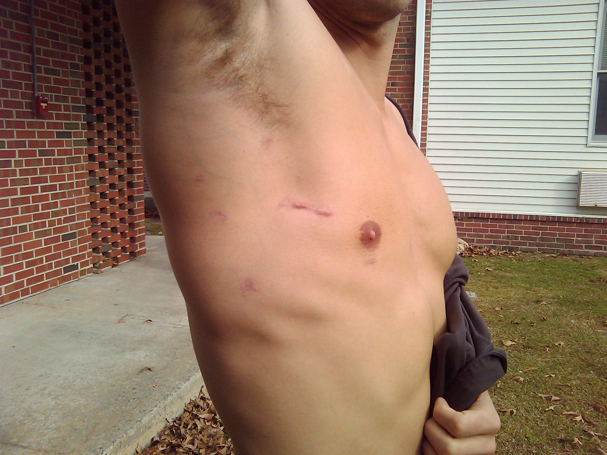 Scars 6 month