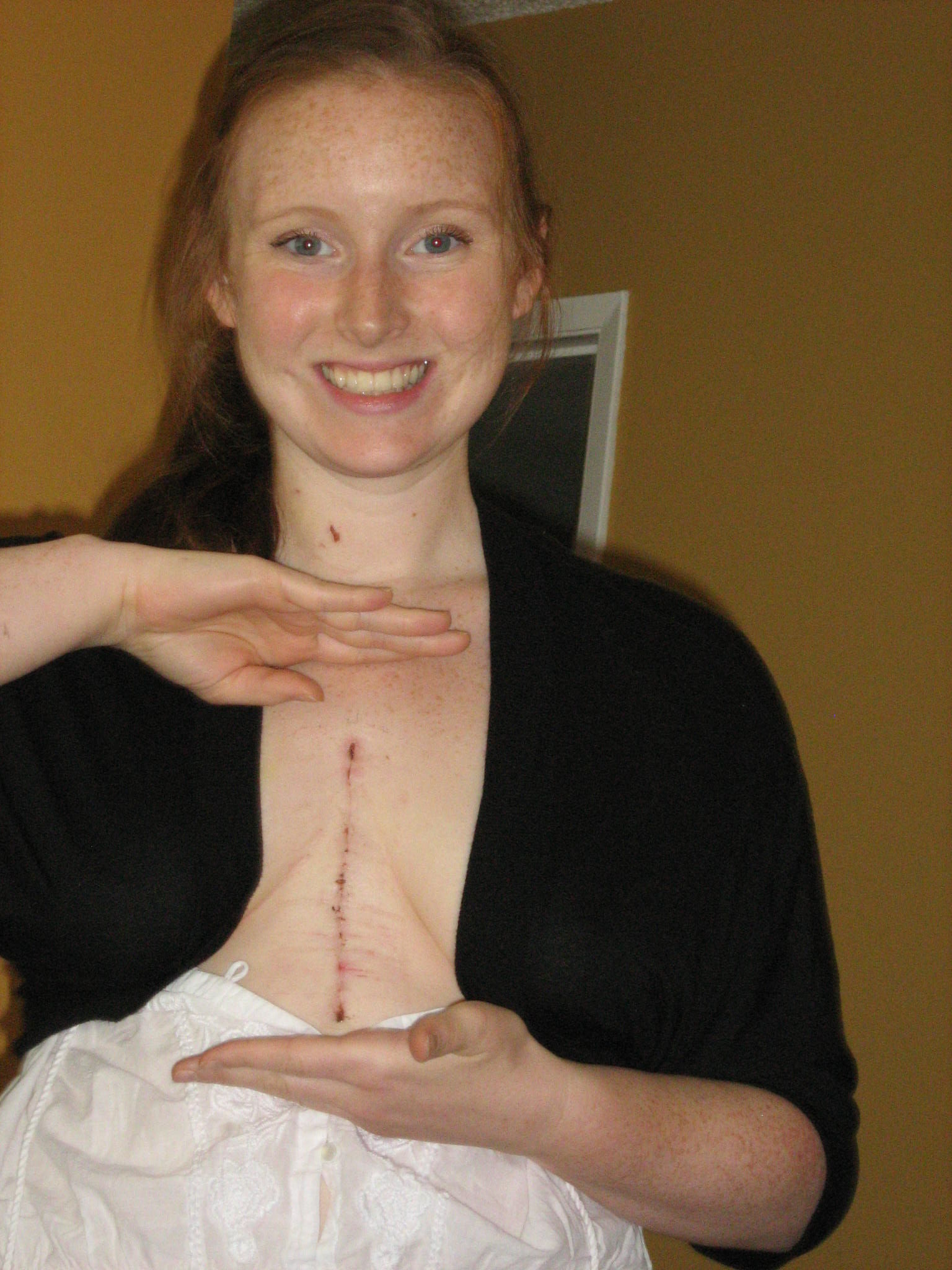One Week Post Op.
