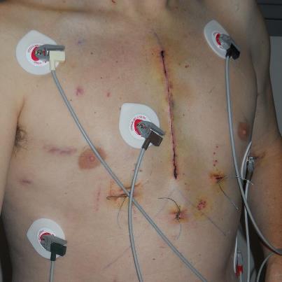Chest Hospital