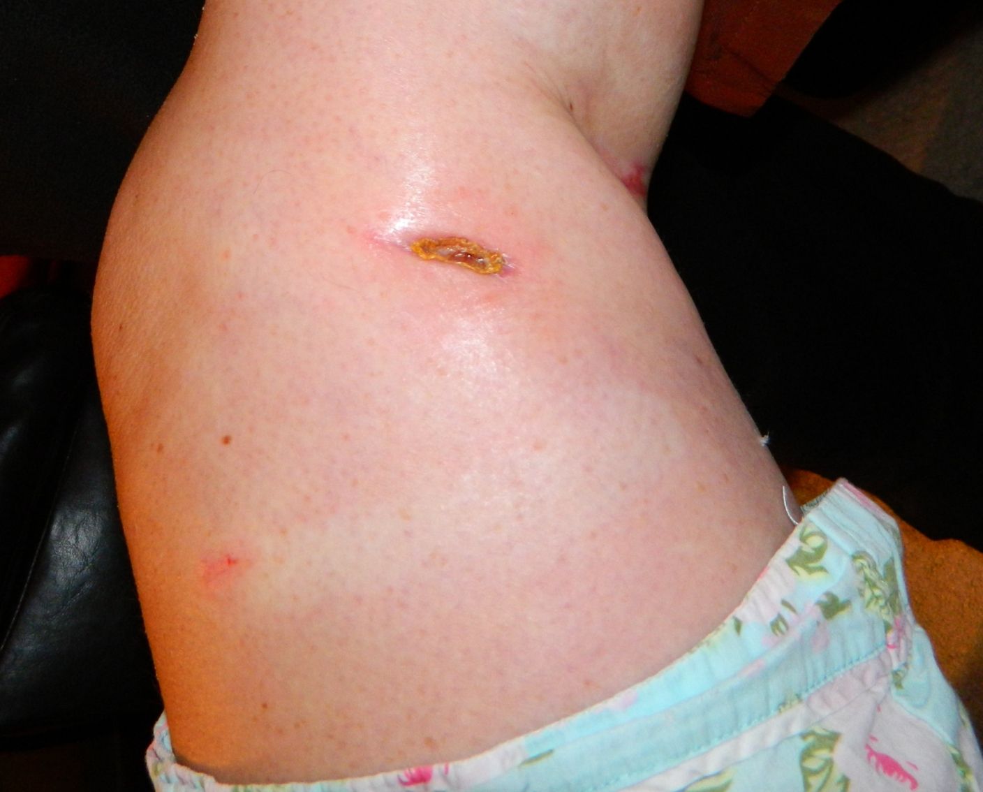 Knee hole finally closing