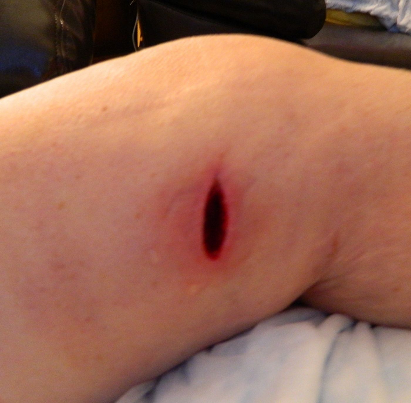 Leg 1-1/2 wks after ecoli removed