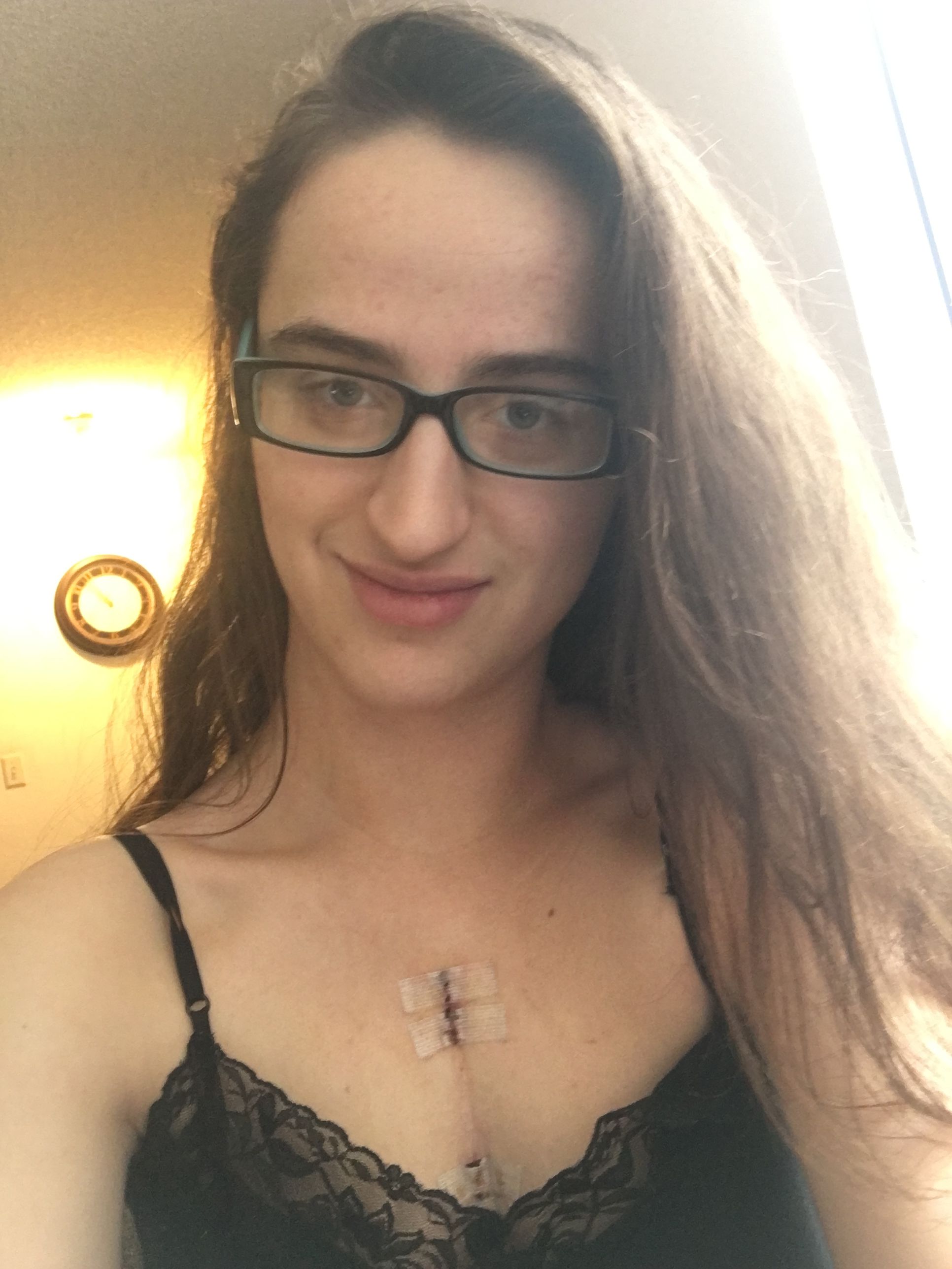 Hello everyone! Three days since my sternal wire removal.