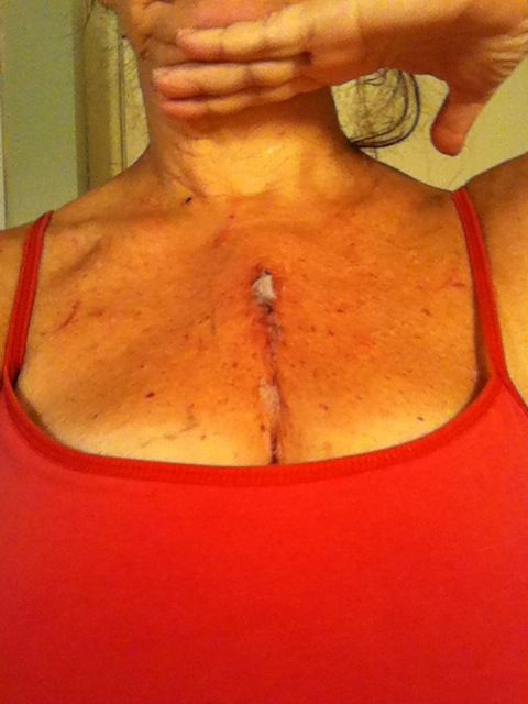 Incision at 8 days