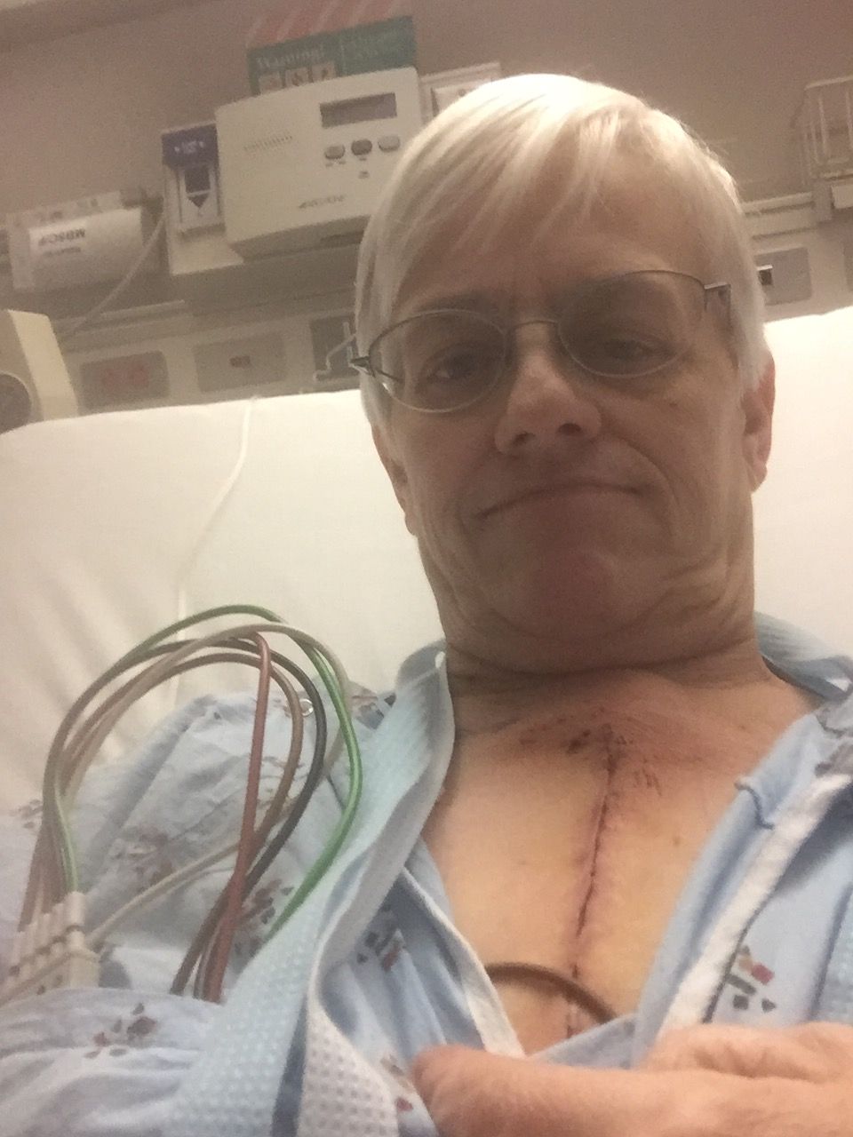 5 days post op. Mainly over first scar.