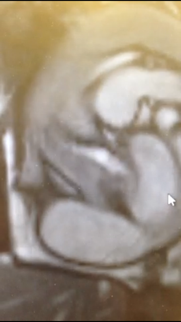 middle of screen white narrow stream of blood. a normal valve blood travels effortless-no white