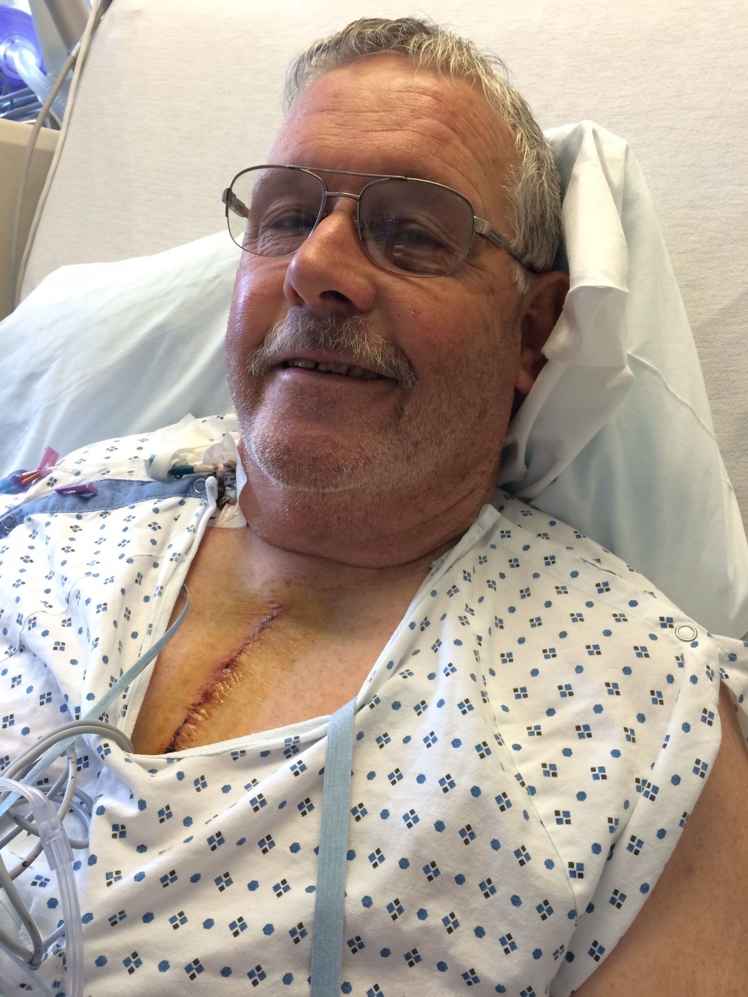 Five days post op still I'm ICU tubes out today (isn't that fun). But finally hope and strength from all of the prayers and positivism both of which are an absolute need. Note to firefighters: DONT BREATHE SMOKE. Firefighter lungs compromise this surger