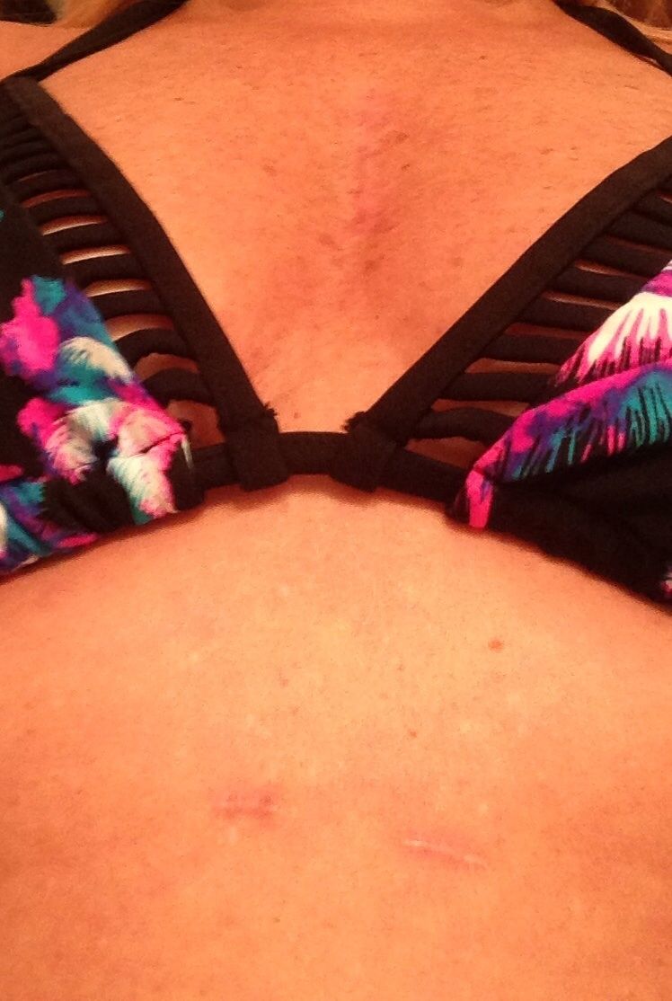 Scars after 14 months post surgery and a Week on the beach. 3 inch mini sternum