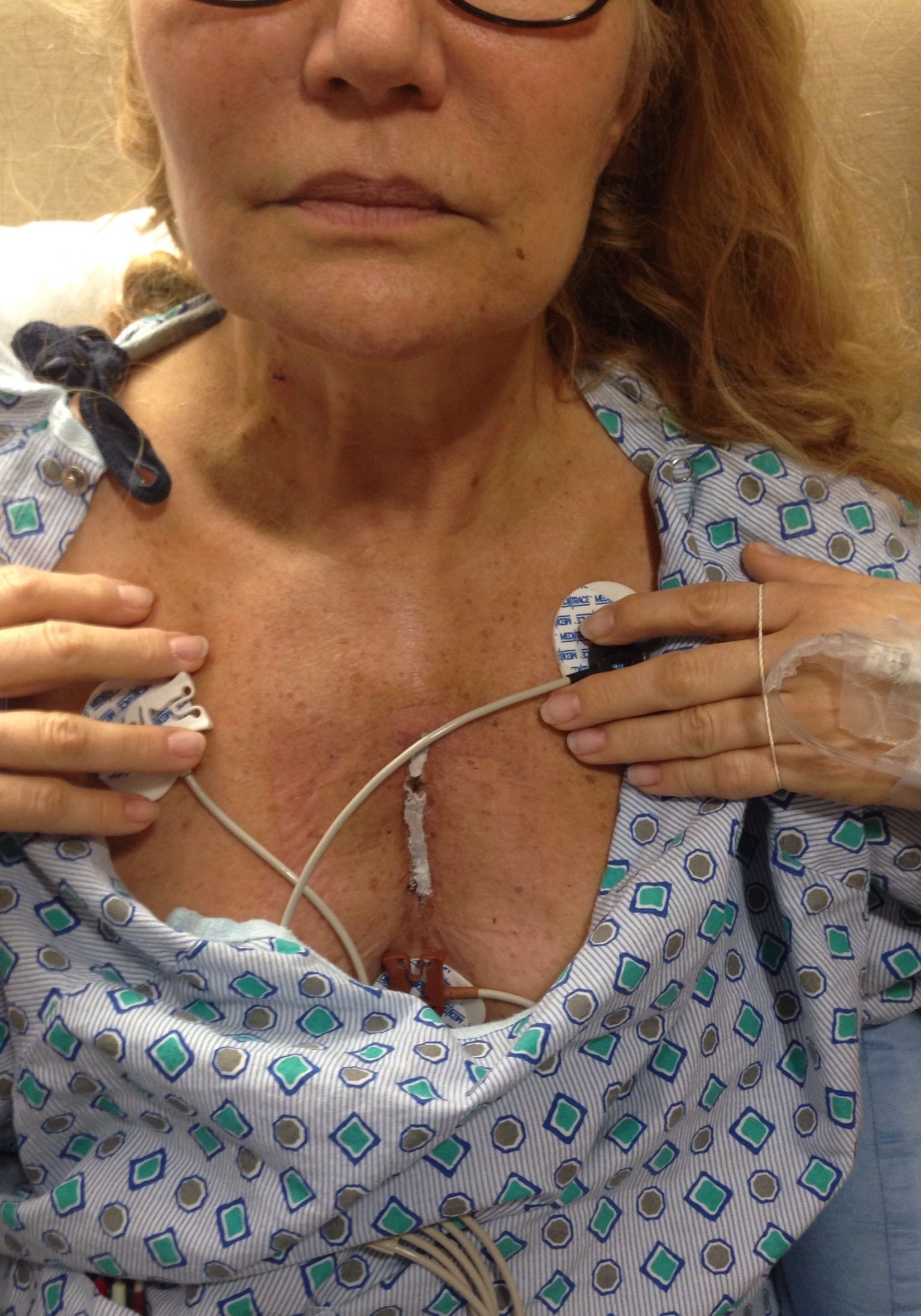 48 hours after surgery with super glue. no stitches or stables