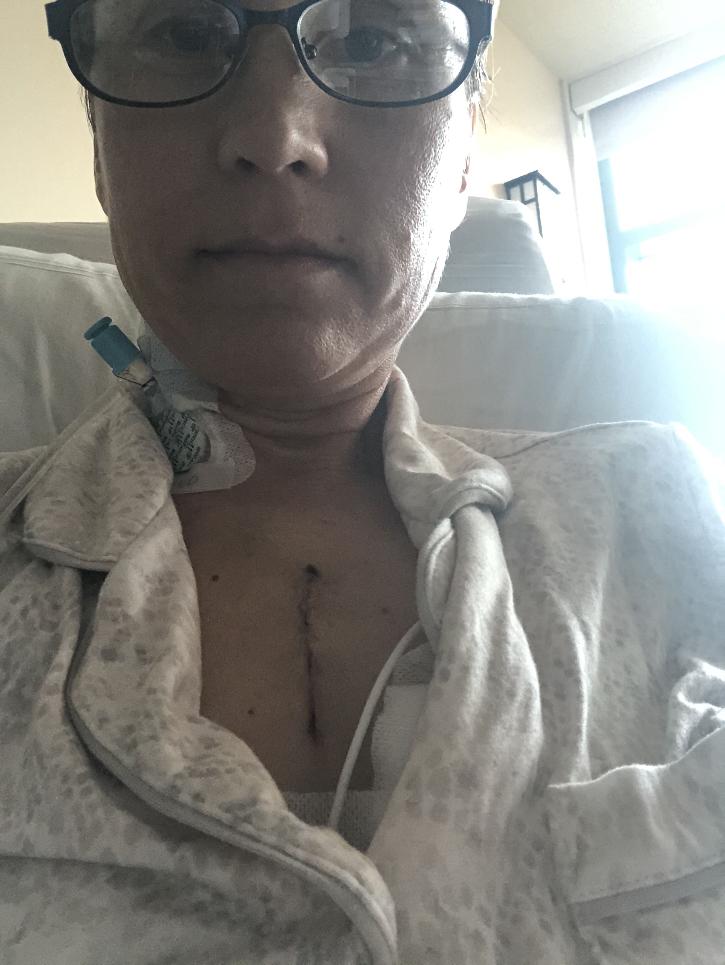 Ministernotomy. Couple days after surgery.