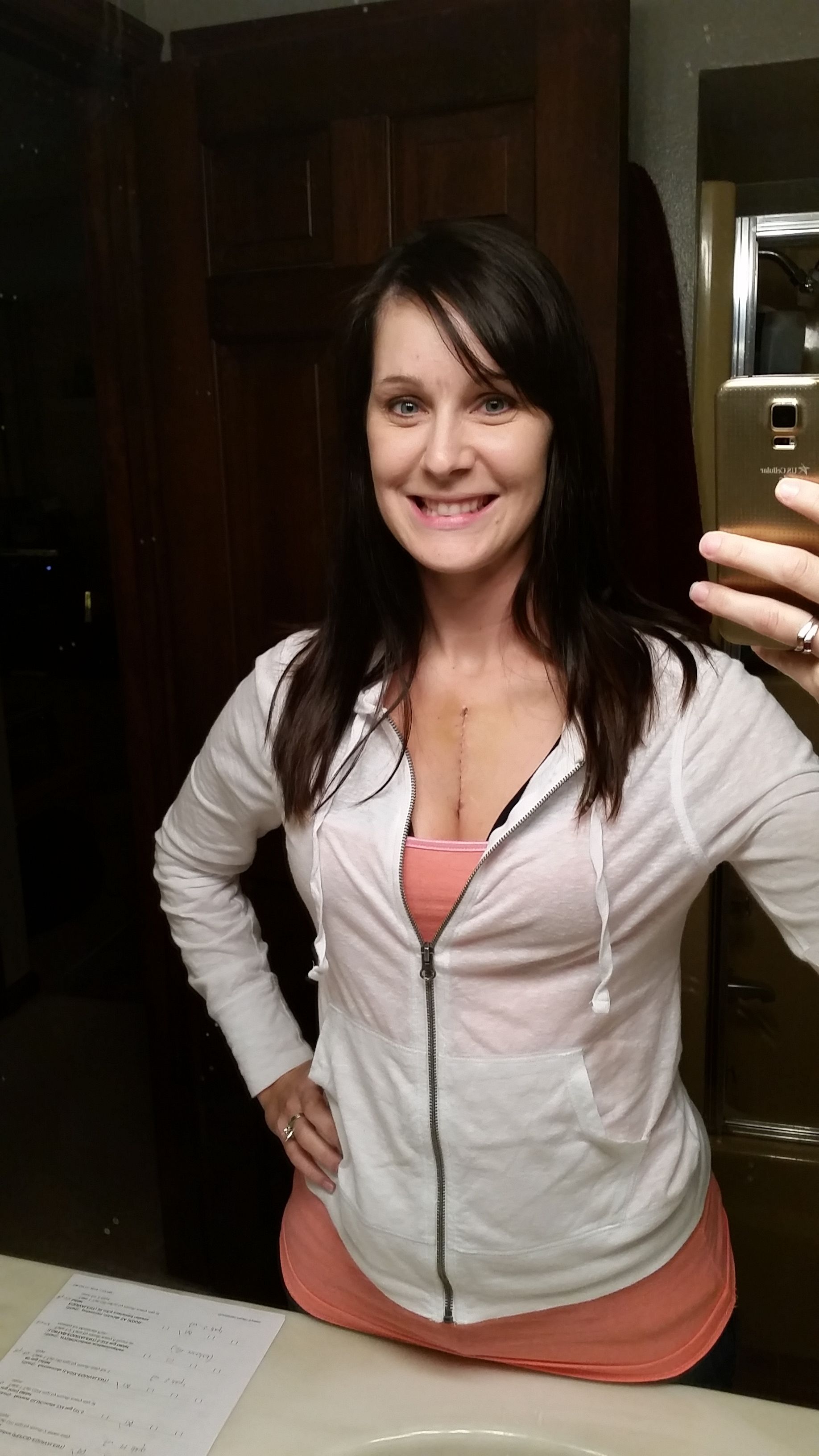 This was taken 8 days Post surgery. It looks even better today, just 2 days difference!