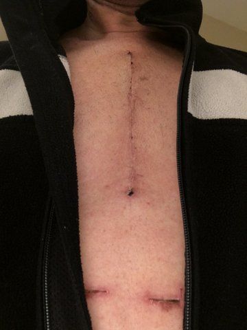 Picture of scar a week after surgery.