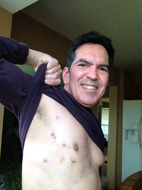My Smiling Scars Selfie: Mitral Valve Repaired, 5 small incisions. Feeling great, thank Jesus!
