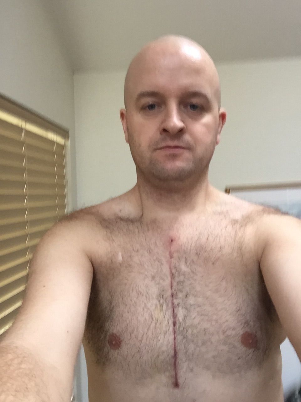4 weeks post op and time to post my smiling scar selfie. 4 weeks post op and snuck in a run on the treadmill. I am starting to feel normal again. I've been cleared to drive, lift my kids and do most things. Going back to work at 6 weeks. Cannot wait!