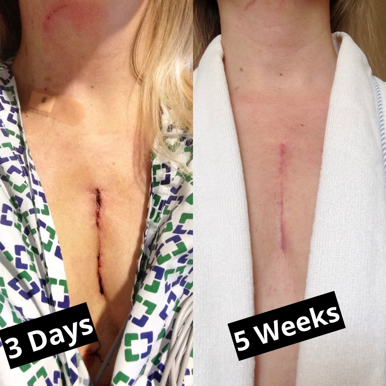 Road to Recovery: Mini-Sternotomy Incision