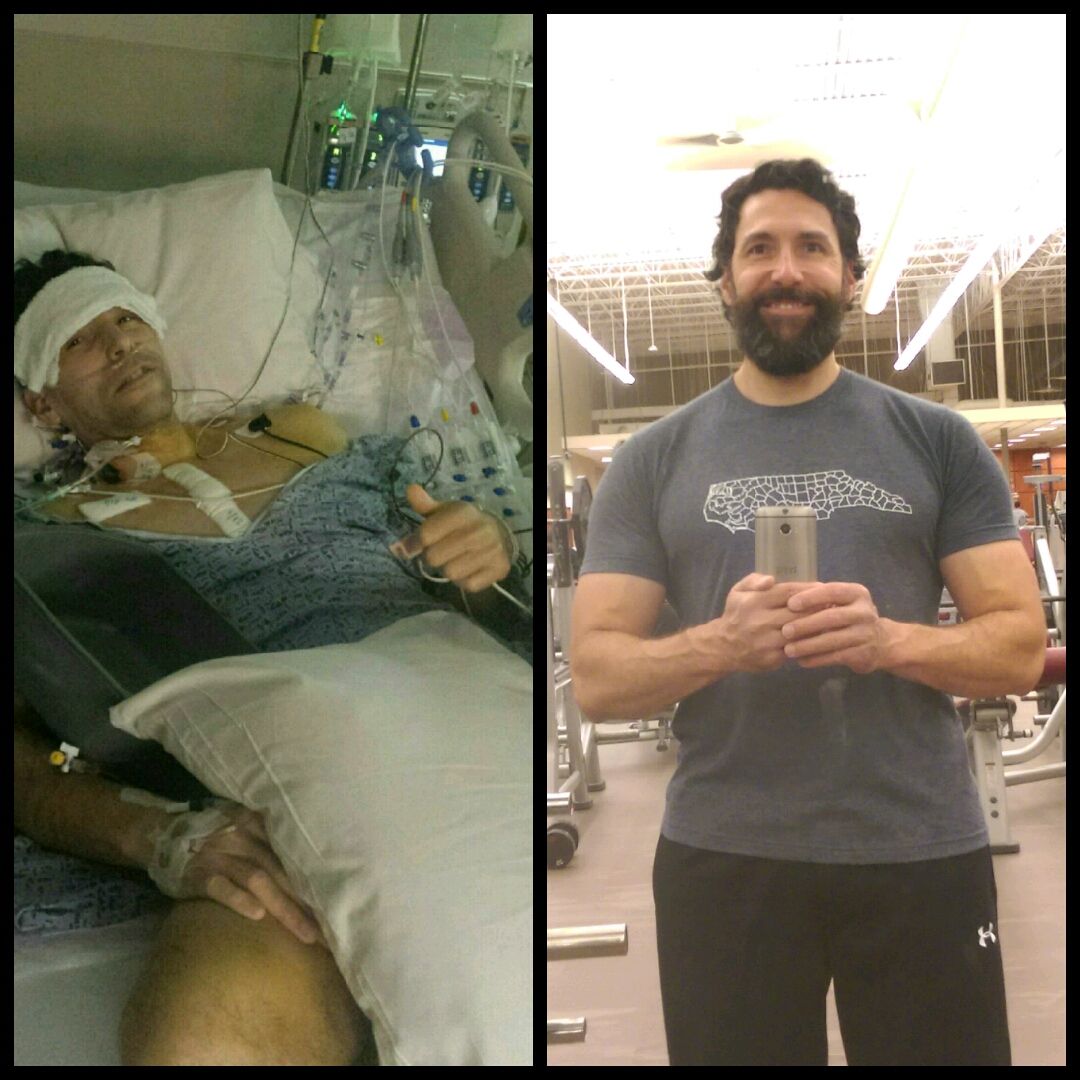 Feeling much better a year later thanks!