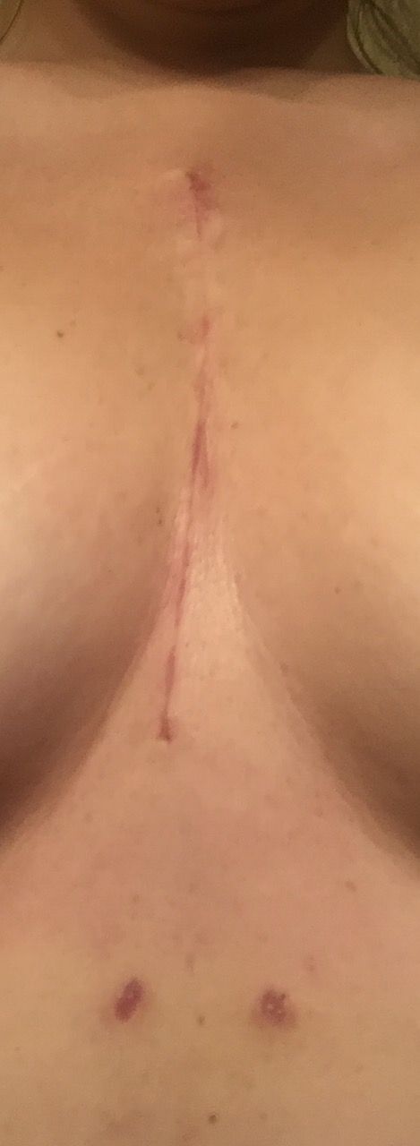 5 weeks - 5 1/2" sternotomy and tubes. Scabs off.