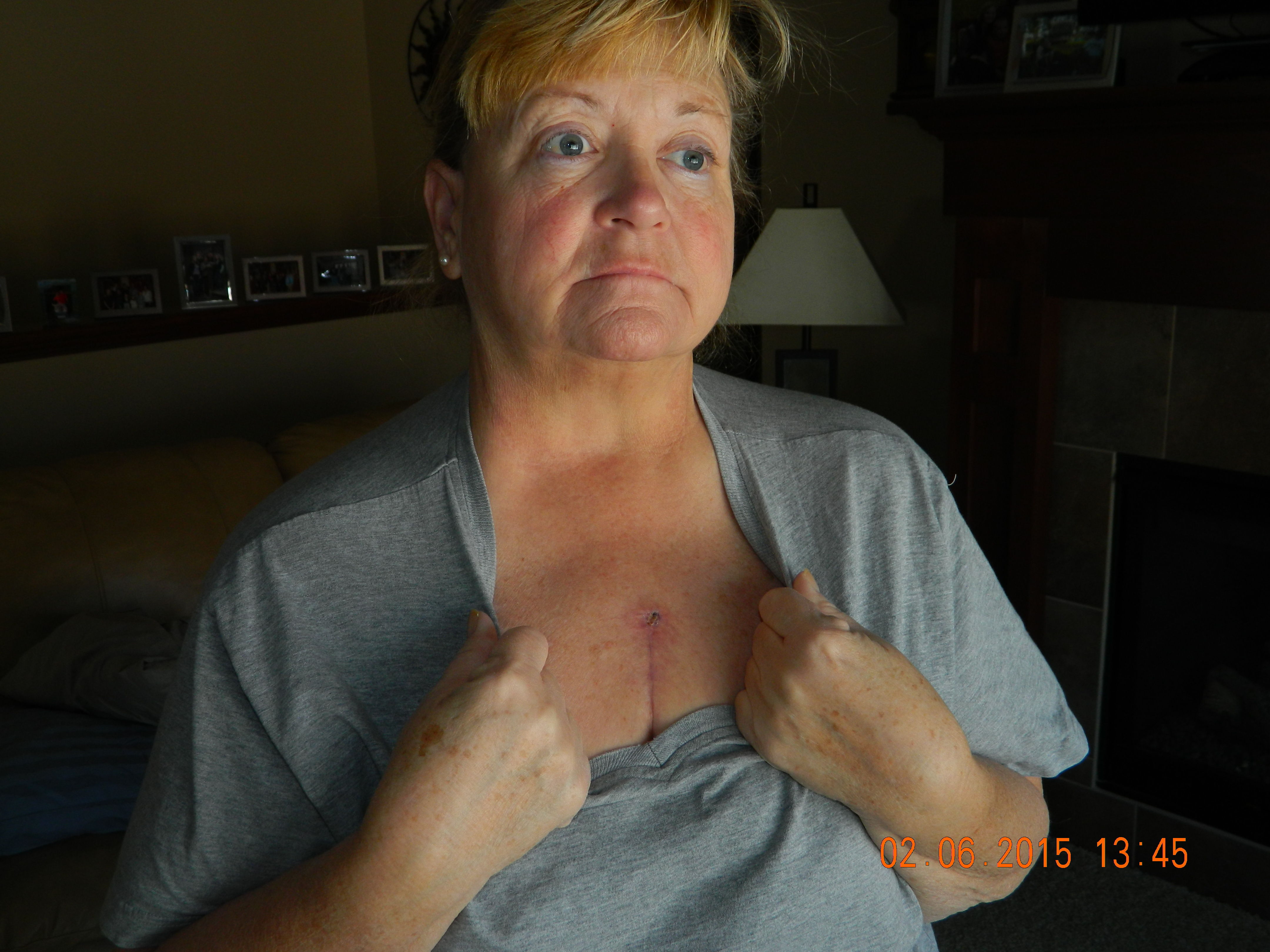 6 weeks post -op. Healing well, yet slowly. This was a mini-sternal incision. Wendy