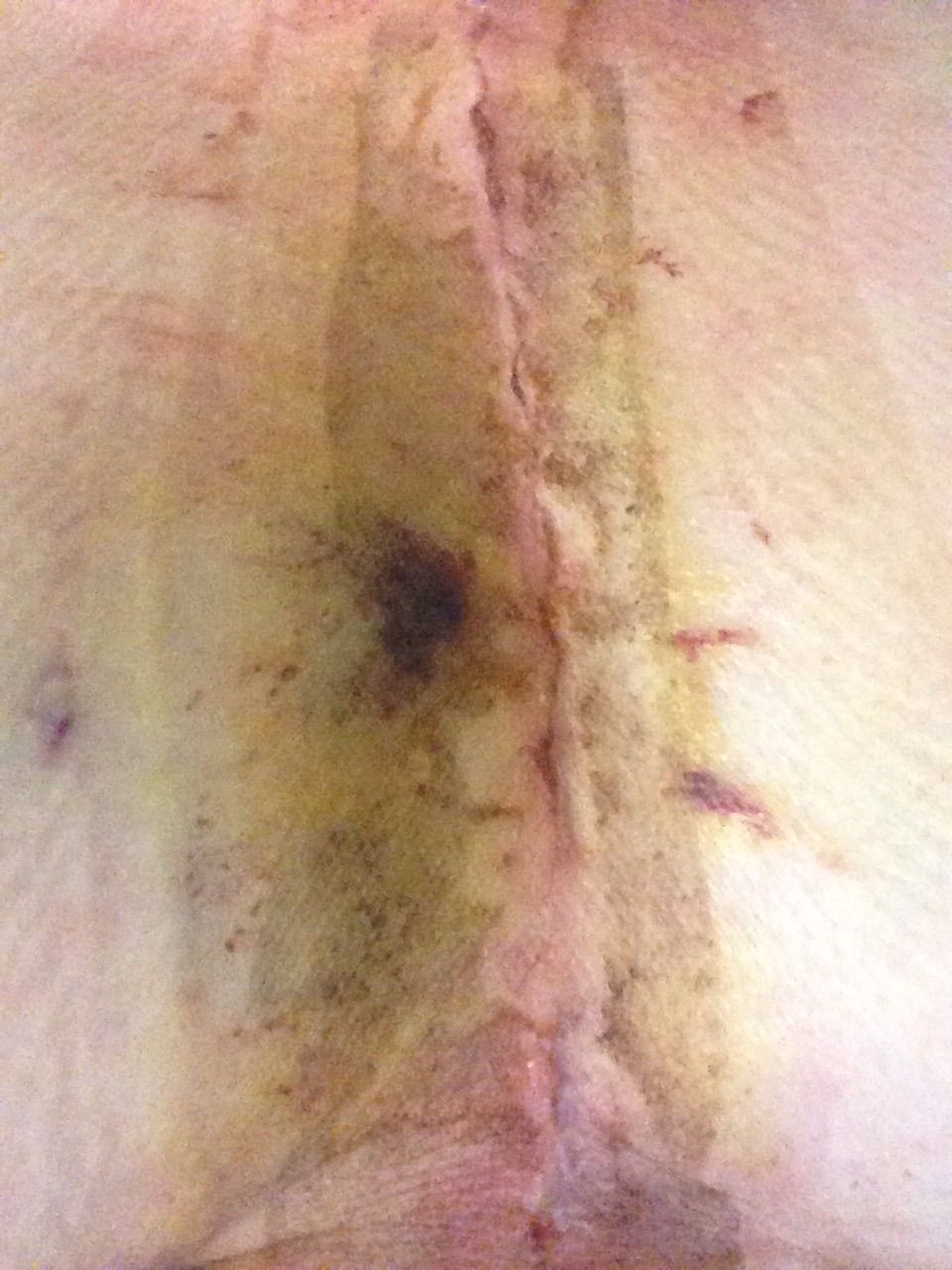 This is 6 days after surgery when they took the bandage off