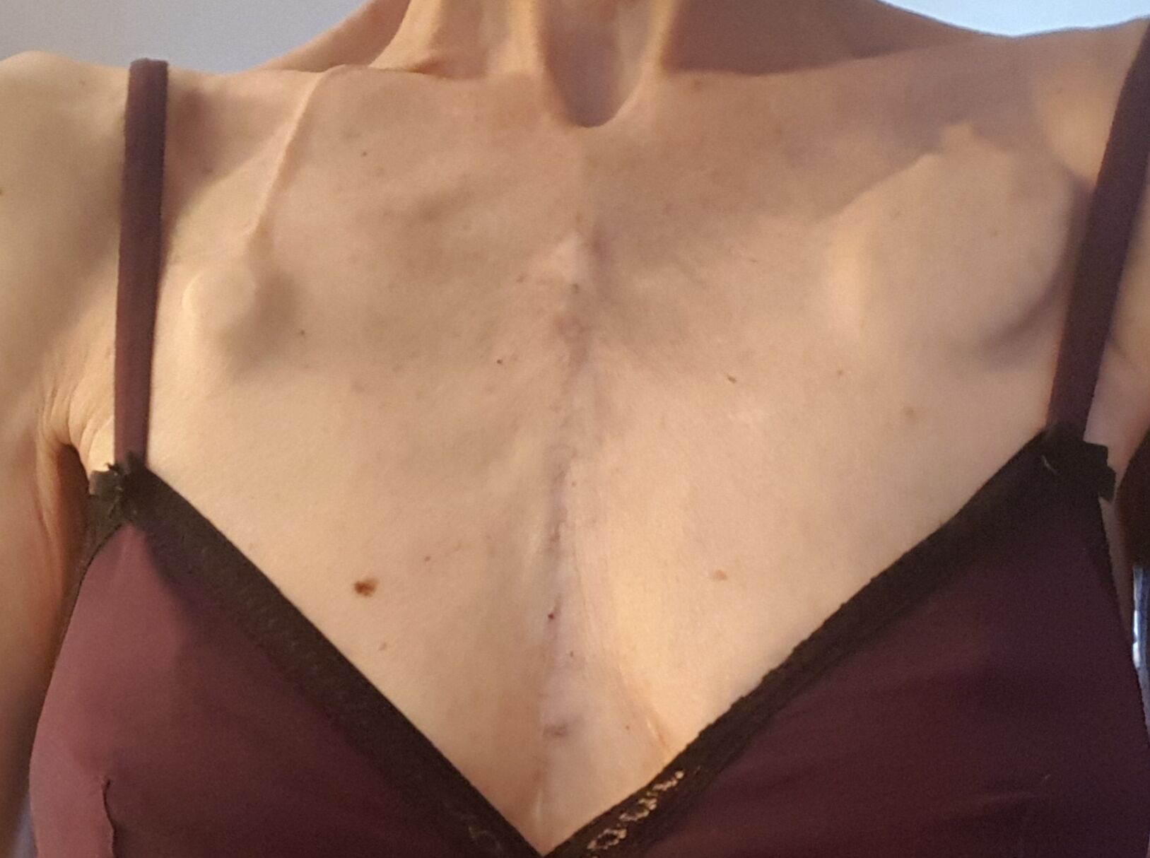 OHS scar from 2015 + pacemaker bulge on my left and new chemo port bulge on my right.