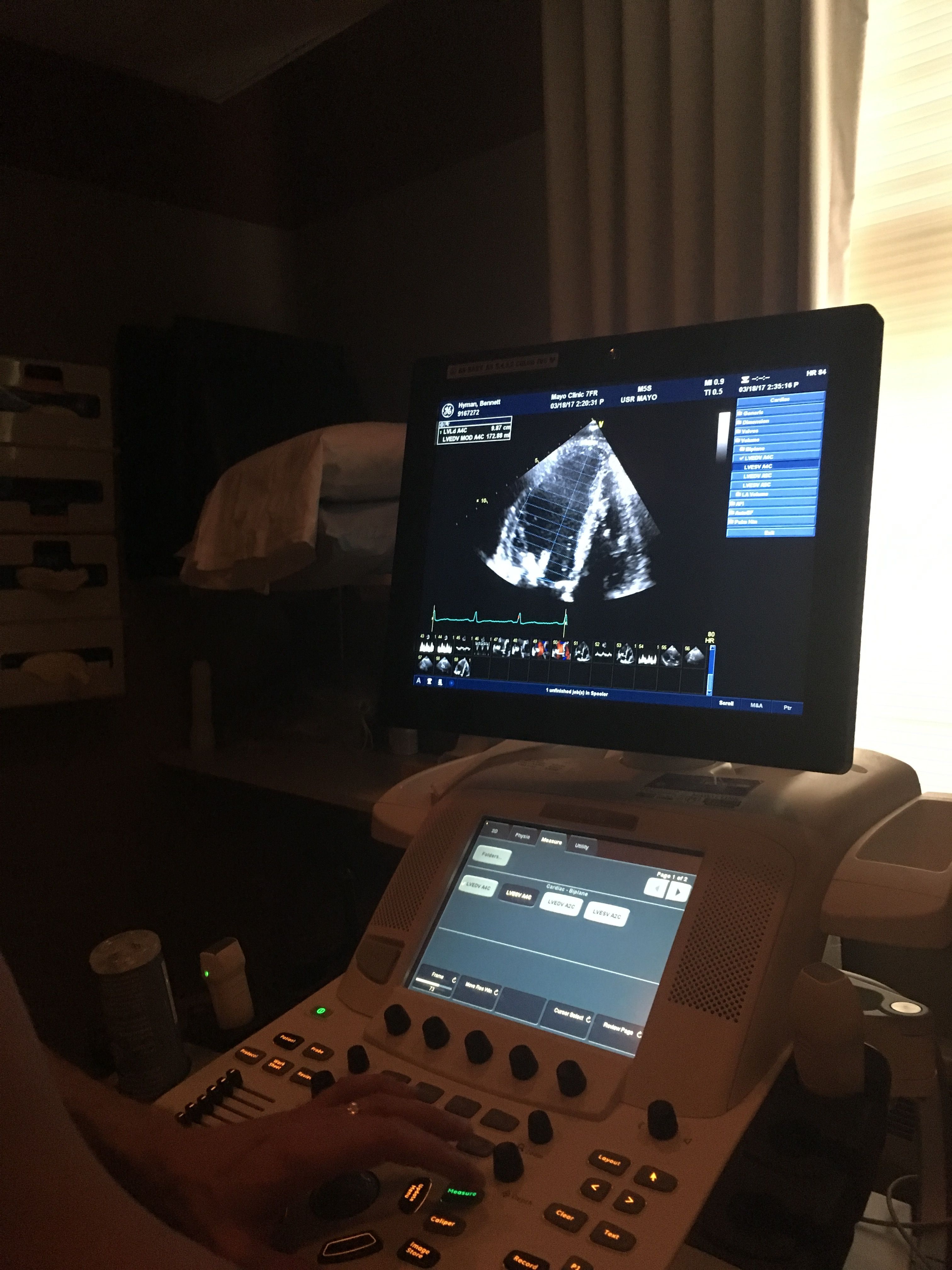 Just had my final echocardiogram at Mayo. Regurgitation is completely gone. My ejection fraction is 55% with normal sinus rhythm .... Woot Woot :-)