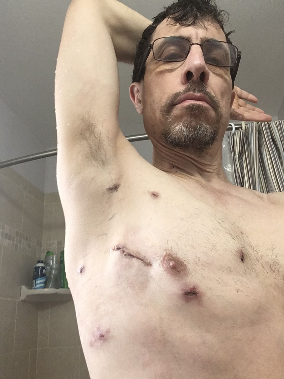 For those of you wondering what the incisions look like for Robotic Mitral repair, here are mine 2 weeks out from surgery