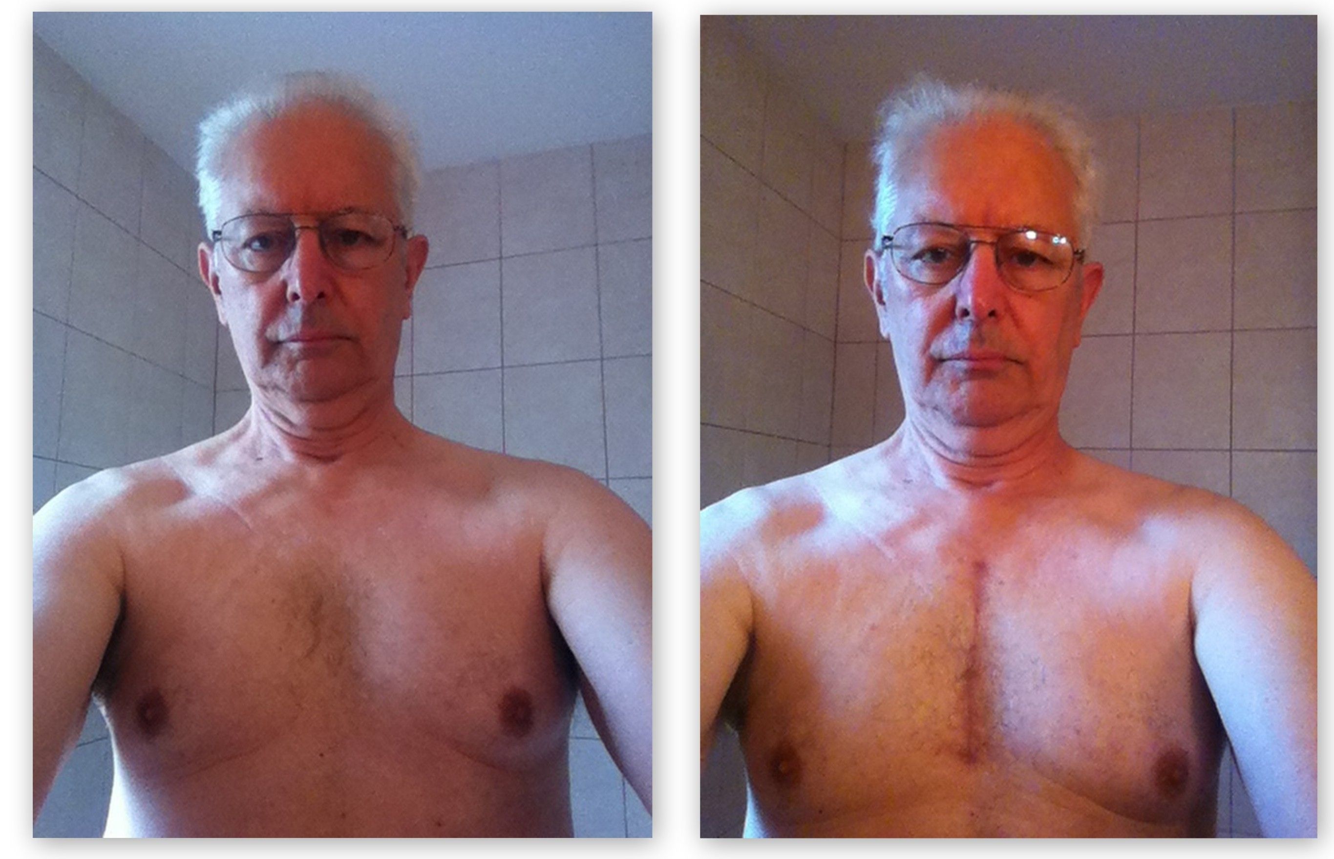 Before and after surgery, April 28th, 2015. about 17 weeks post-op. Feeling 99% back to normal. PTL