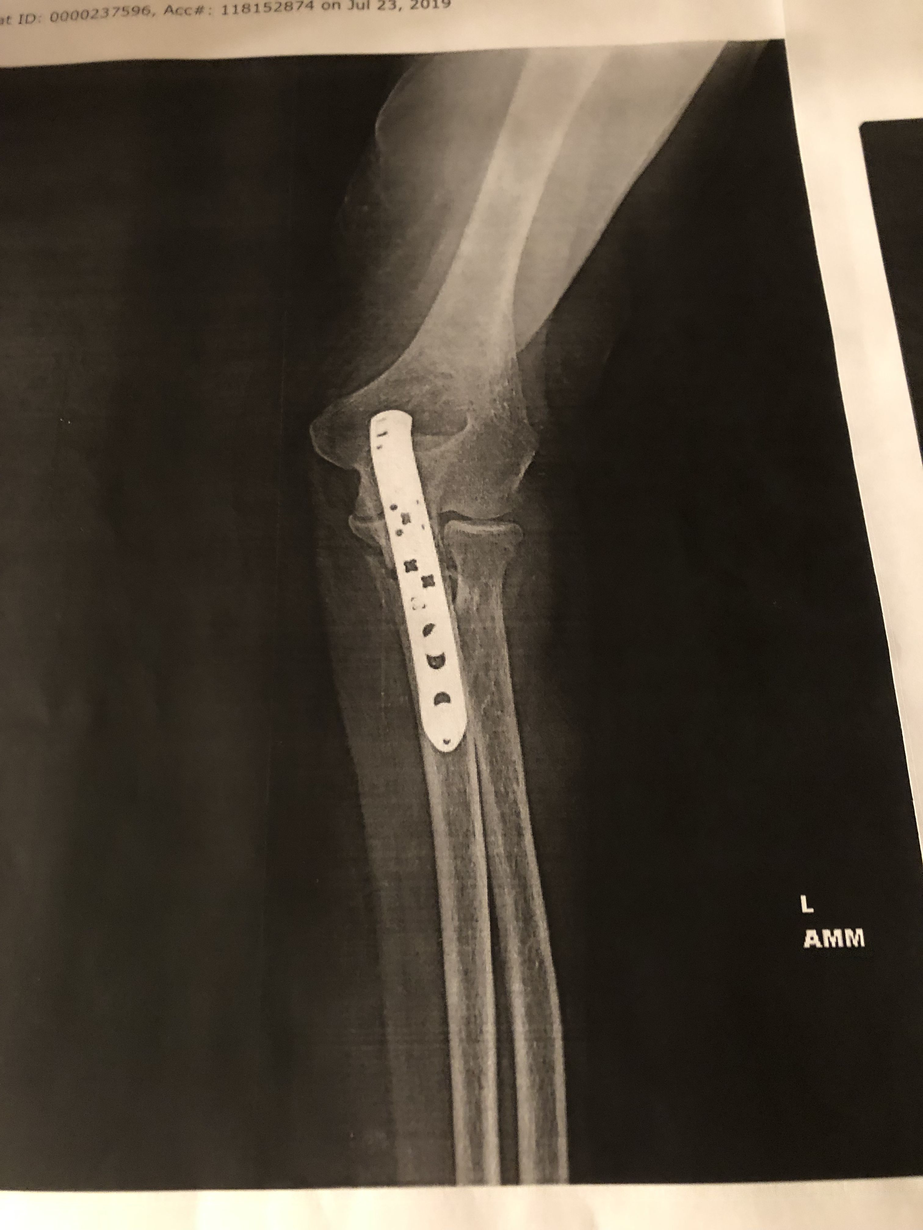 July 4,2019 a tragic fall lead to a broken L. Elbow