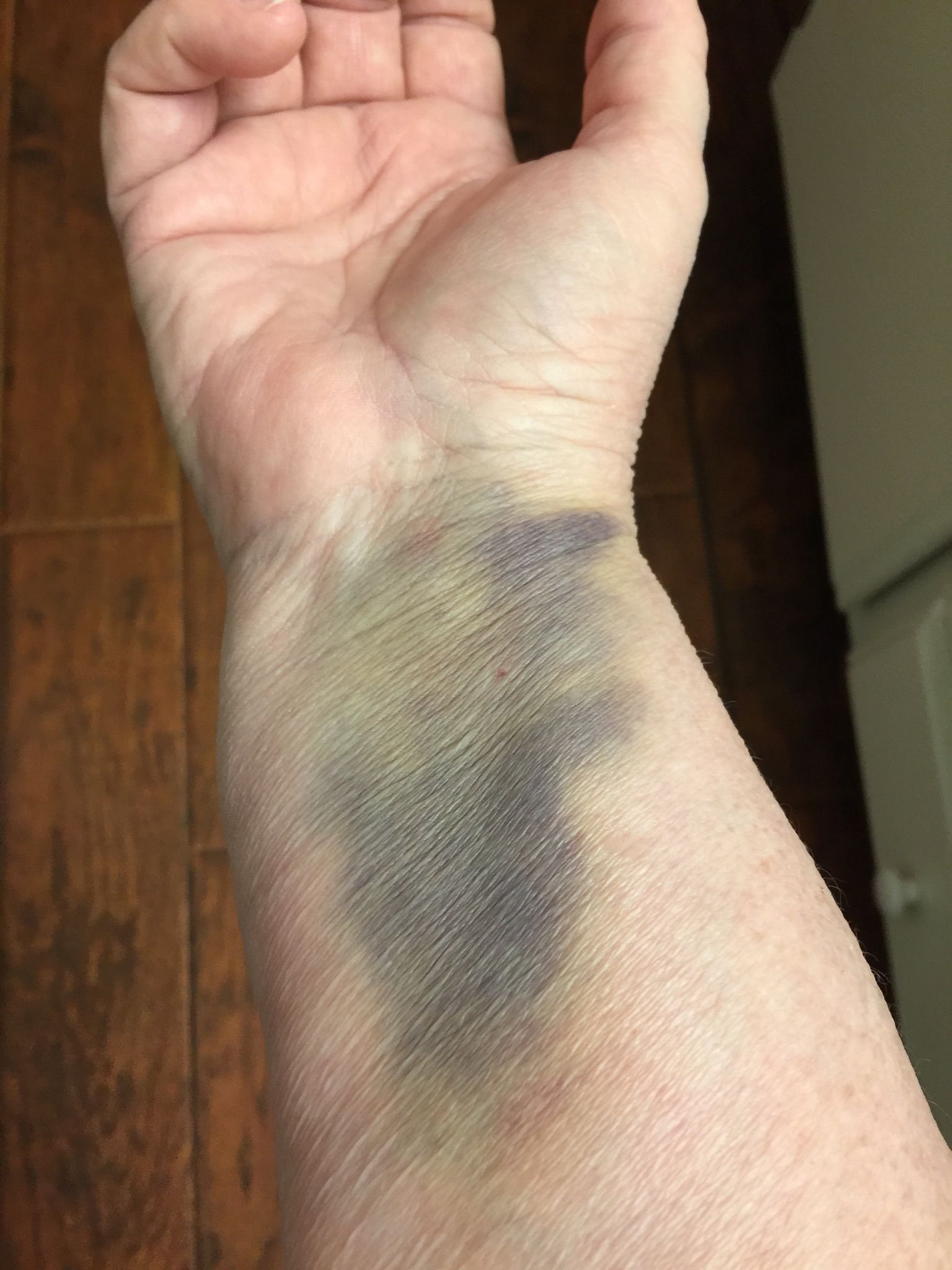 Just wondering if others had this much bruising from the angiogram ??
It only hurts if I touch it firmly.