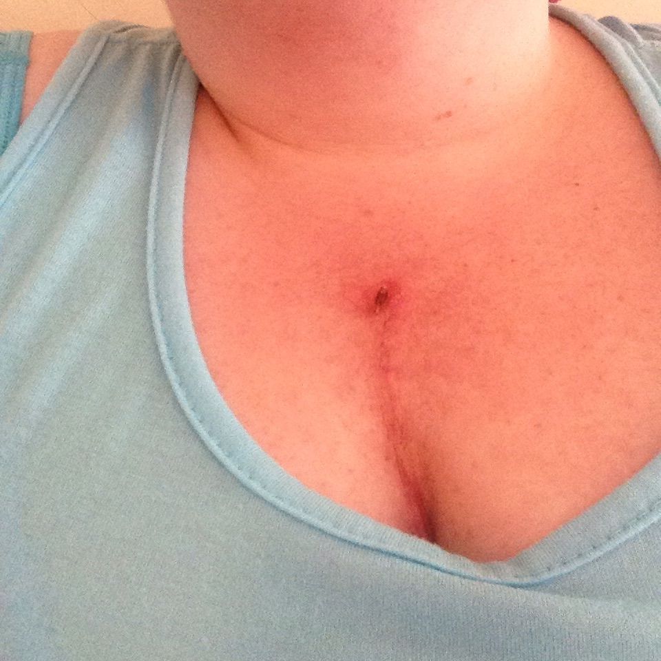 I was 3 weeks post-op on Wednesday!! I'm pretty proud of how my incision looks! And except for the coughing and a pounding heart beat every so often I'm feeling pretty good! I can't believe how far you can come in just three weeks. After surgery I thought