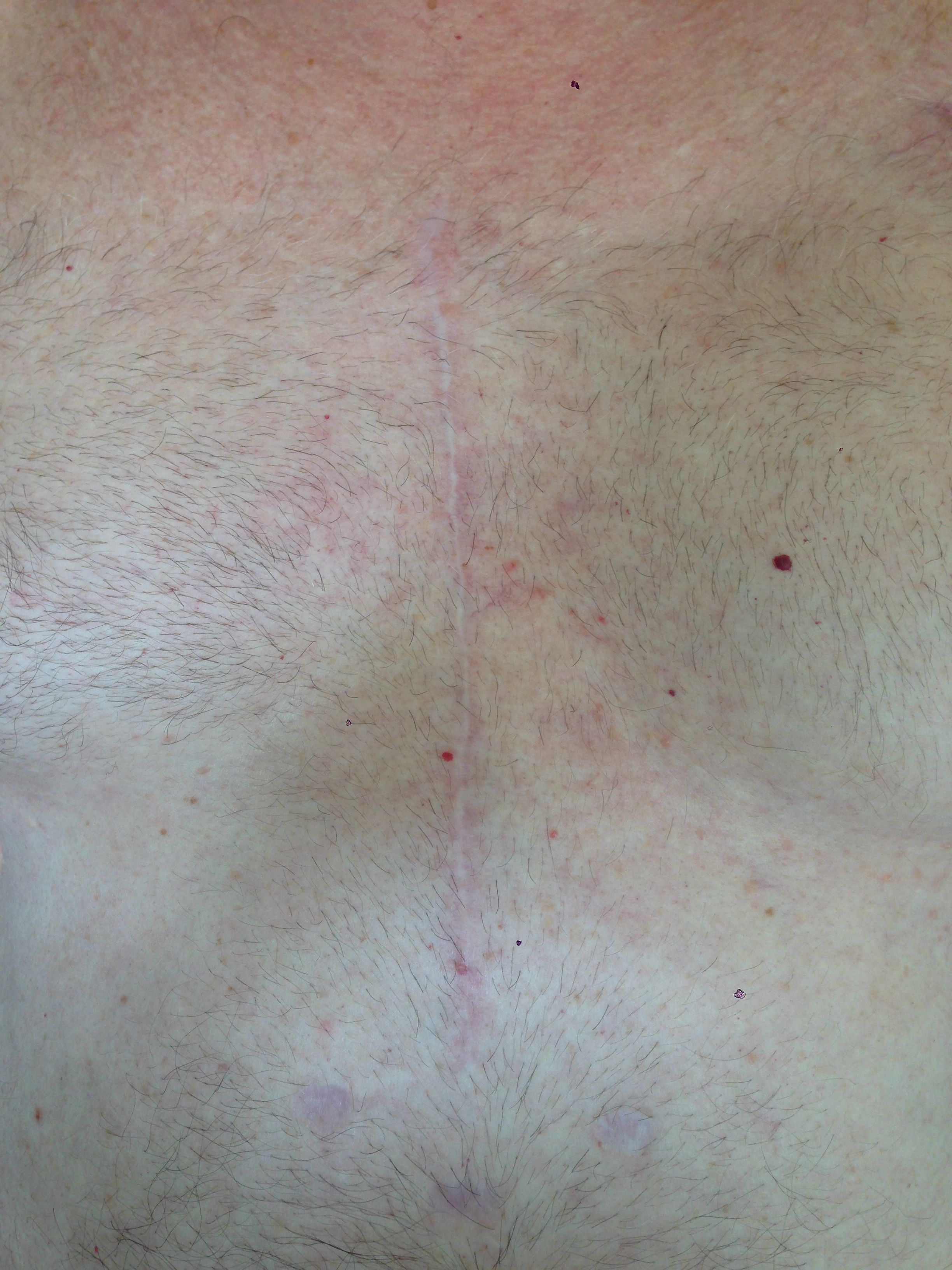 Celebrating 9 Months Post OHS (08/21/15). I think it's healing pretty nicely, although I'm still looking for my beach bod somewhere in there.