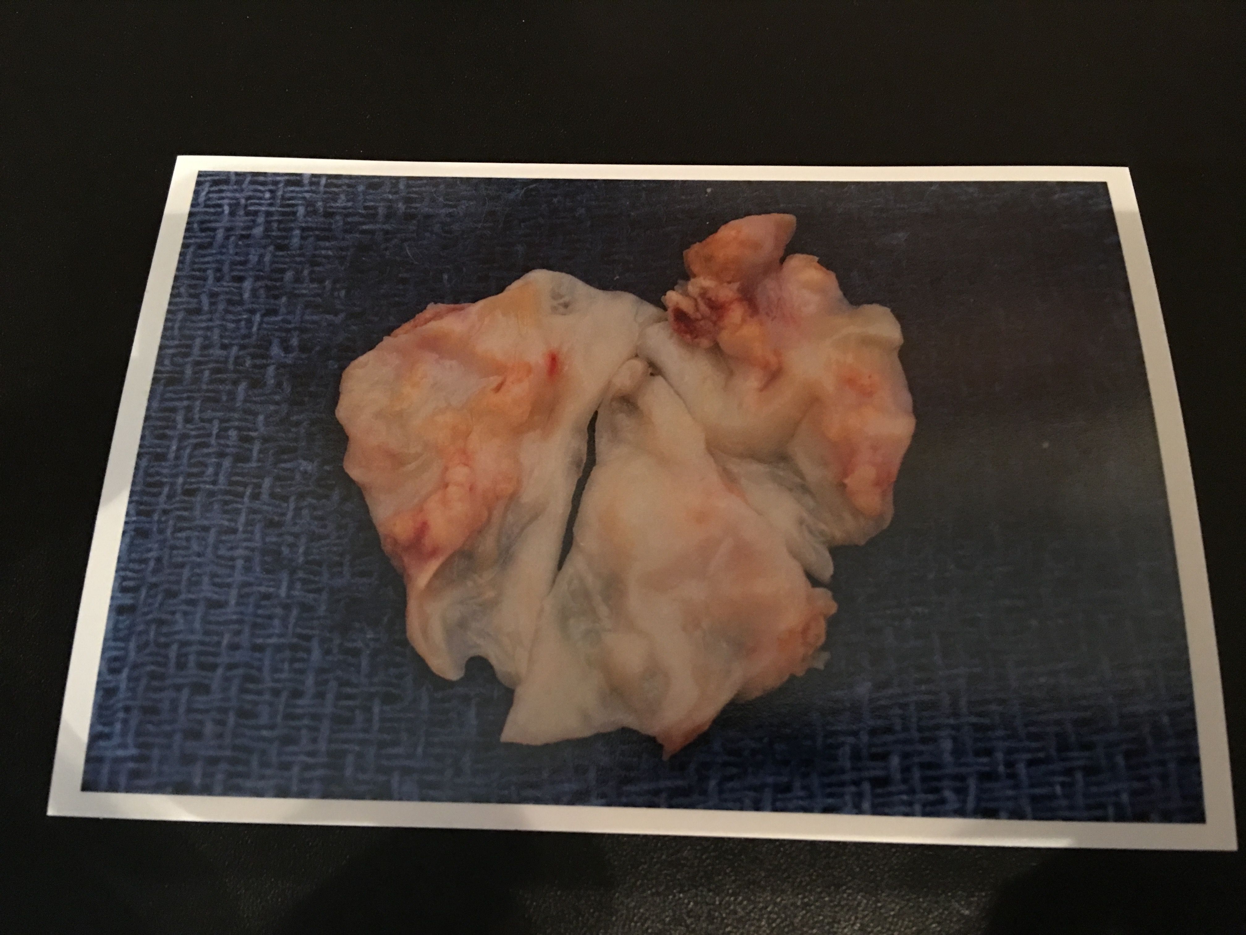 That was my Aortic Valve. Looks more like a vagina! A slit for an opening...and I was working and bowling up to surgery!