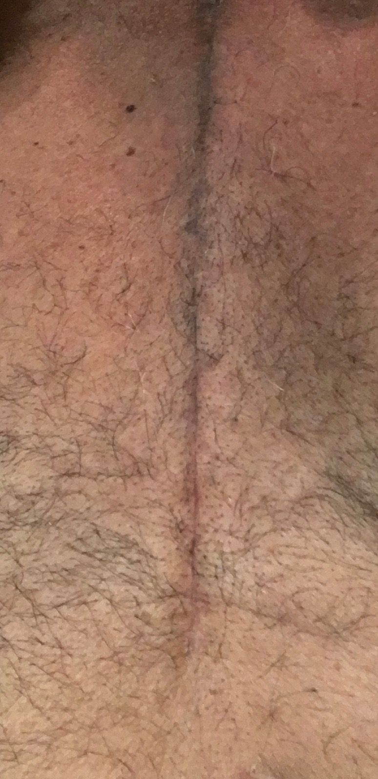 6 weeks post-op...good thing I work there!