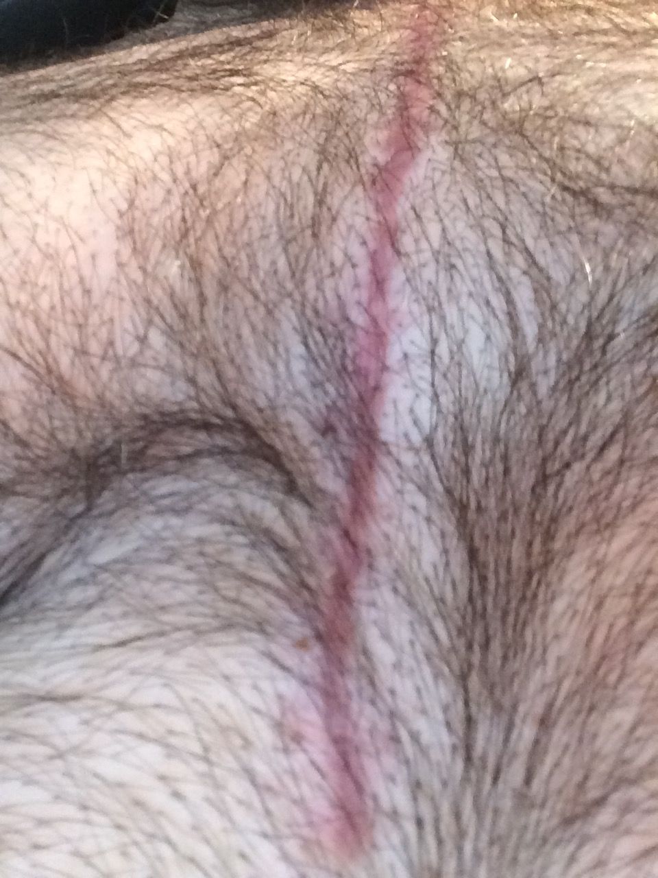 My scar is doing pretty good at three months out still have sternum pain but I guess that takes a while to go away