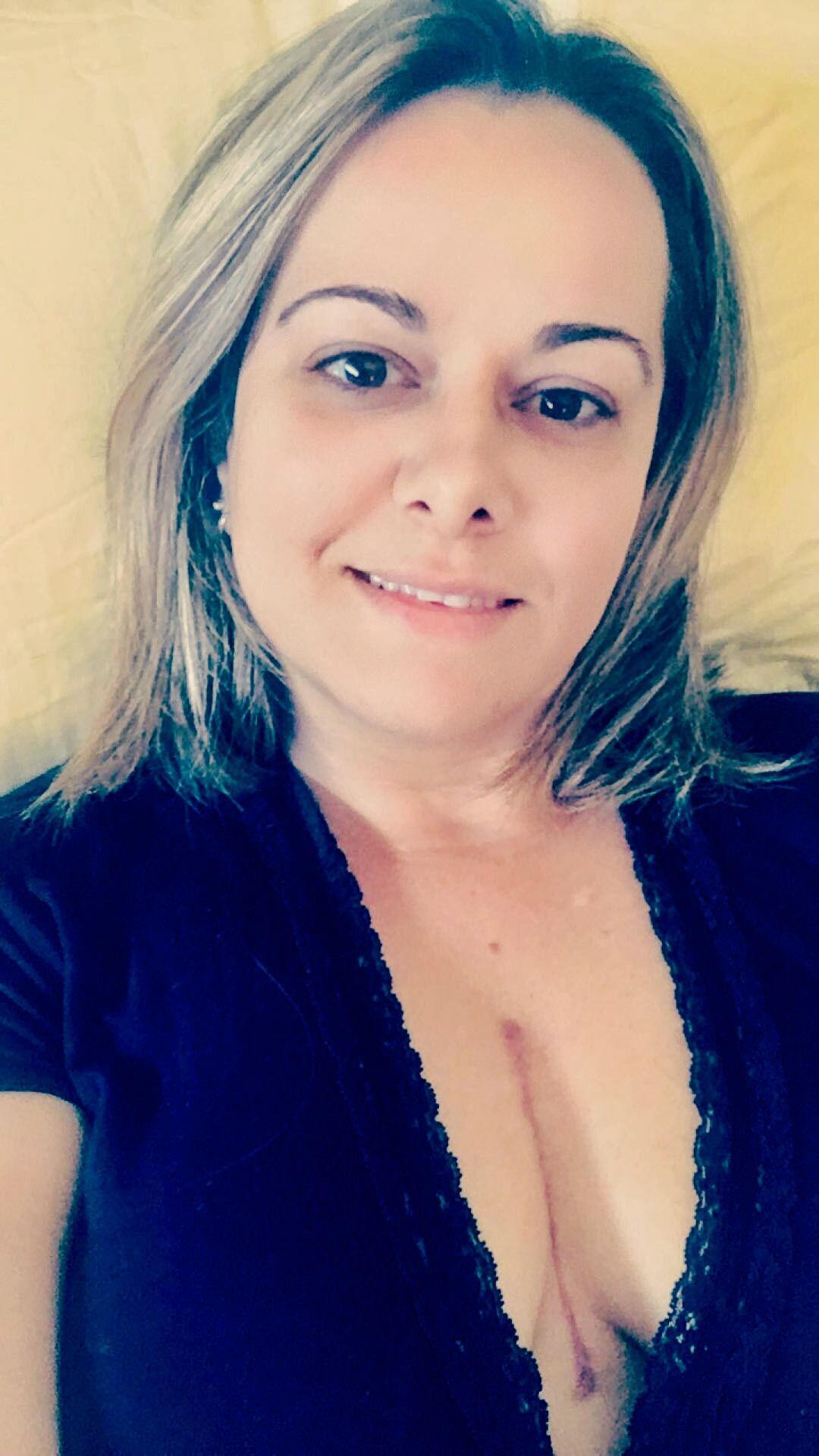 6 weeks after.... I was very interested on scars after OHS during my research period.... here is mine in case you are wondering..... Not as bad as I was expecting.... my Amazing surgeon Dr. laks did the smallest incision possible!!! I am 95% recovered at