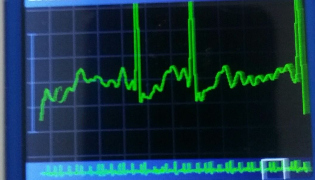 Been in bigeminy for about a week now. Cardiologists not so concerned but with existing low cardiac output I feel drained