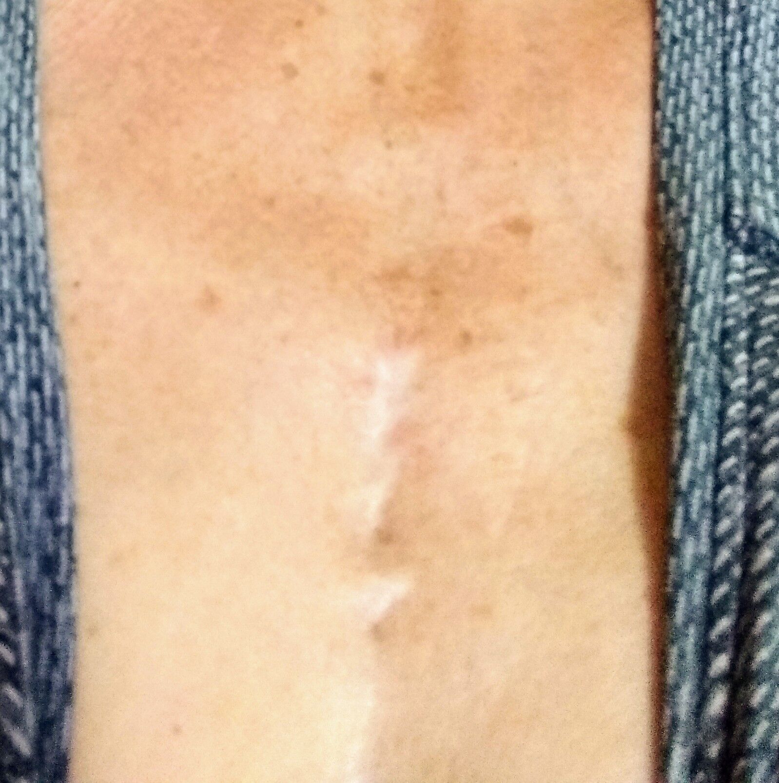 My scar. I feel very fortunate!