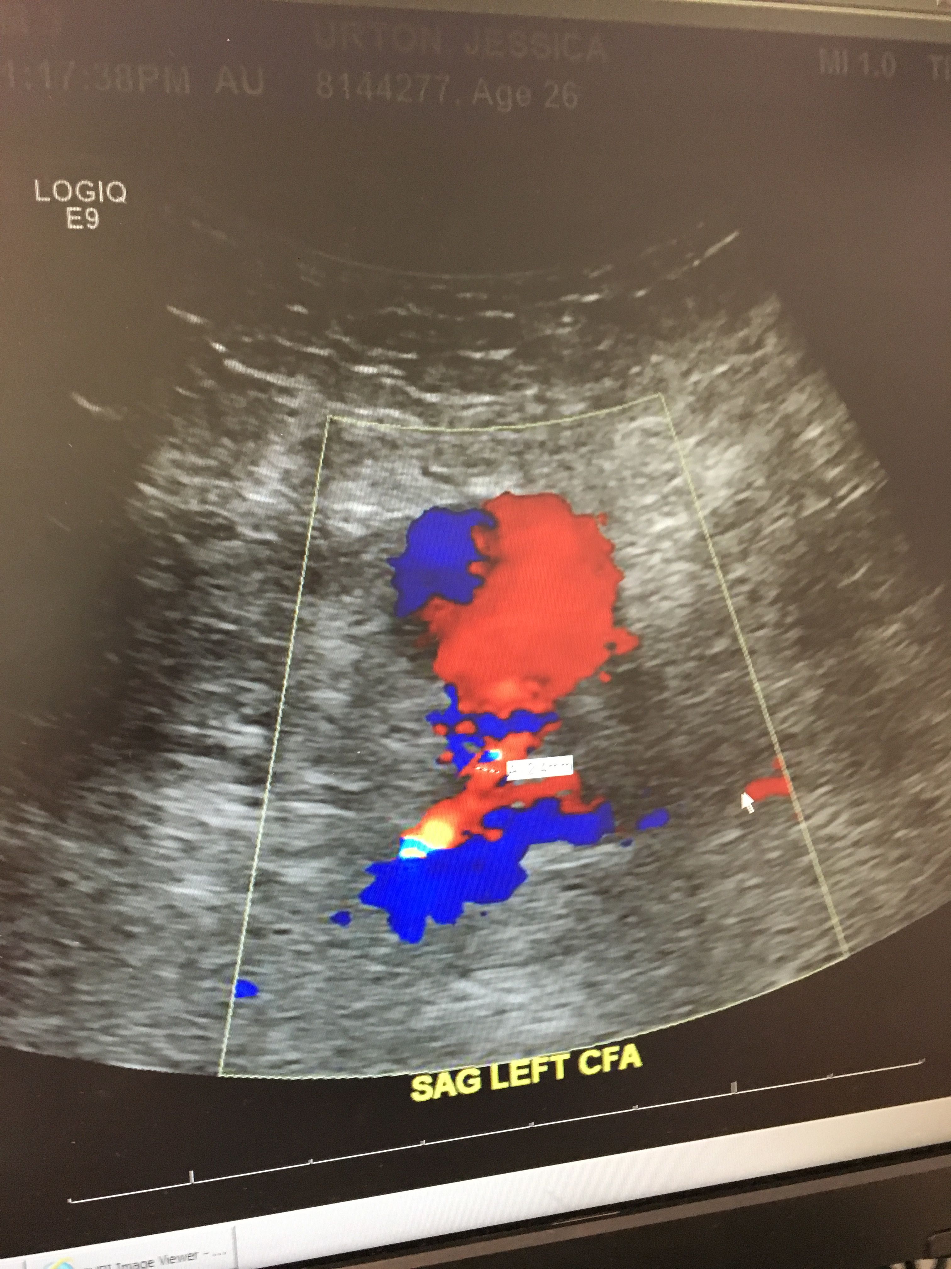 The Pseudo aneurysm before the compression therapy!
