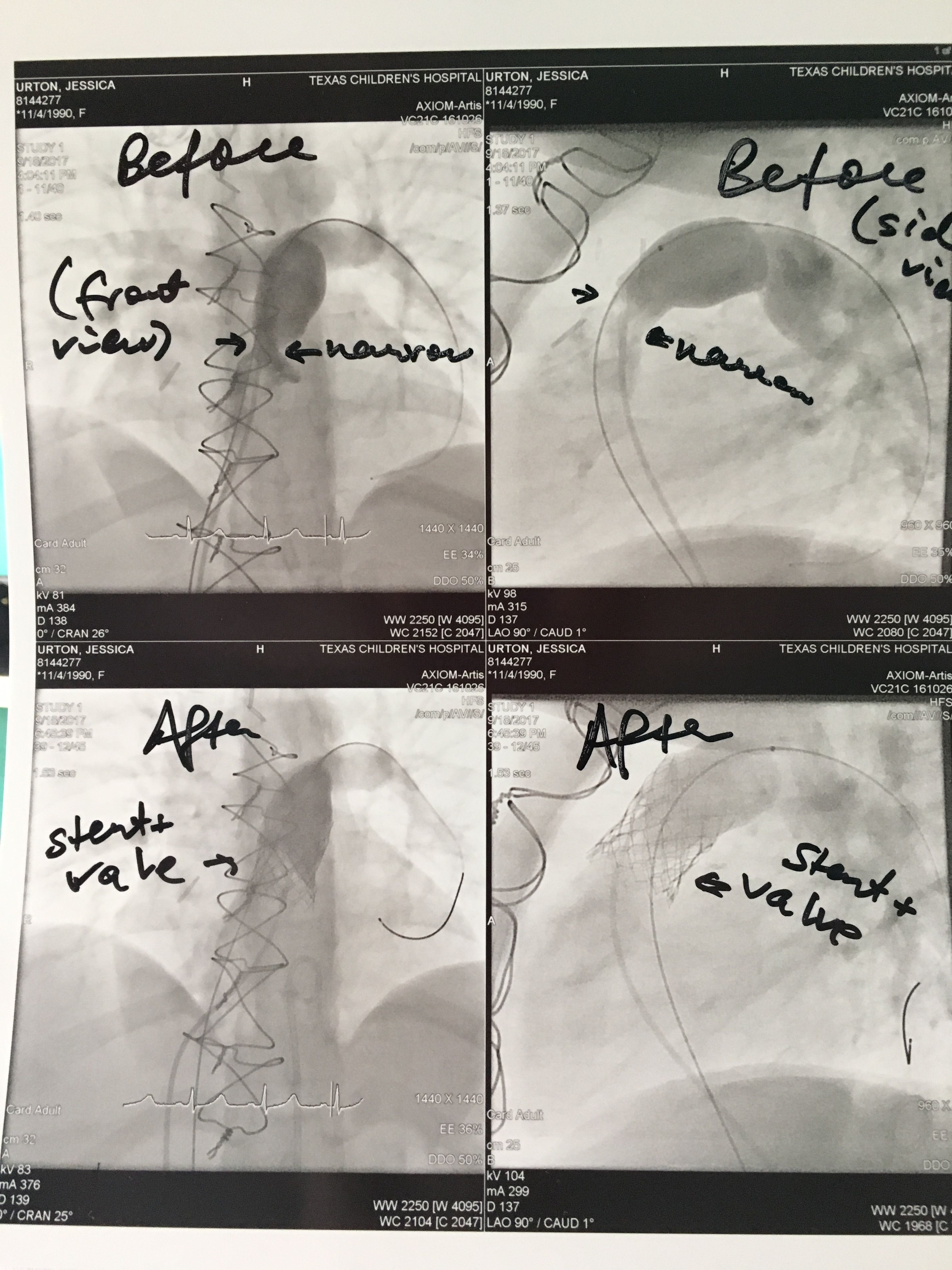The before and after photos! My doctor explained that the stenosis was much more severe than originally observed. They were very pleased with the results!!