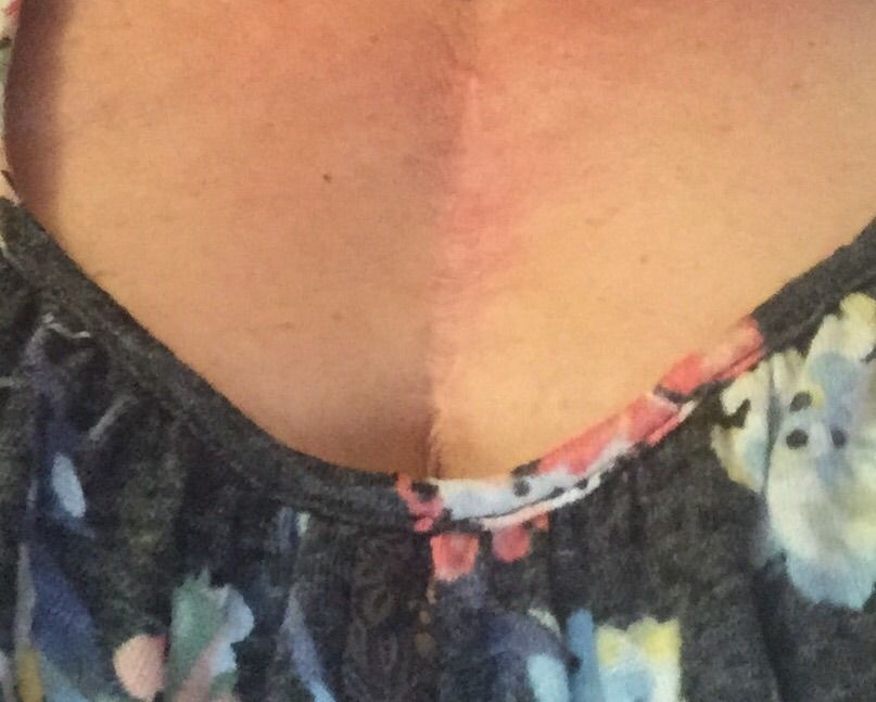 My scar 9 1/2months post-op AVR done on 8/18/2015