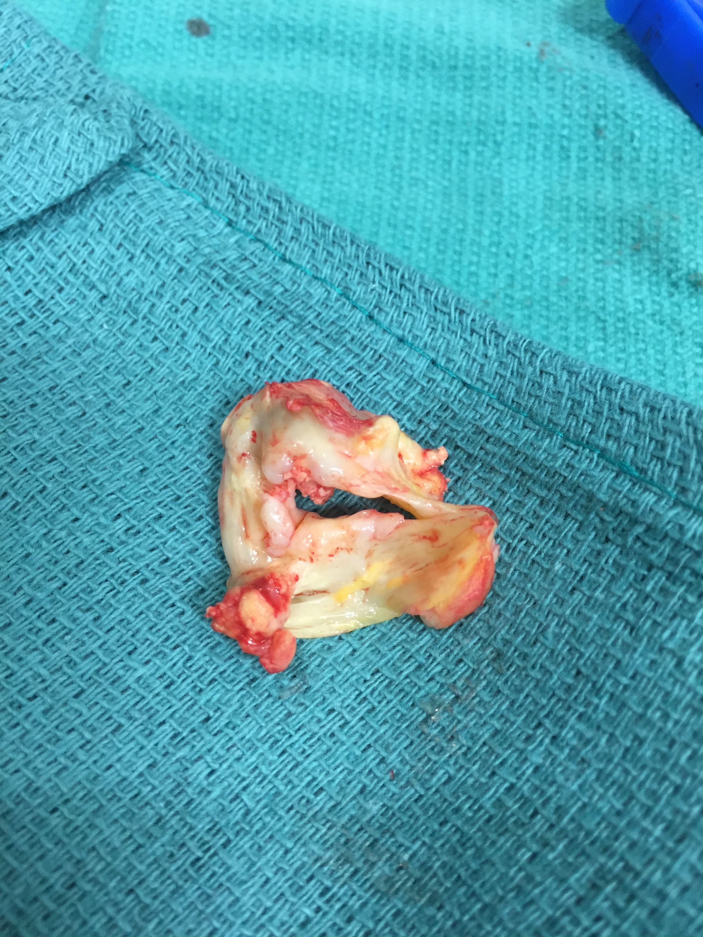 My (former) aortic valve.