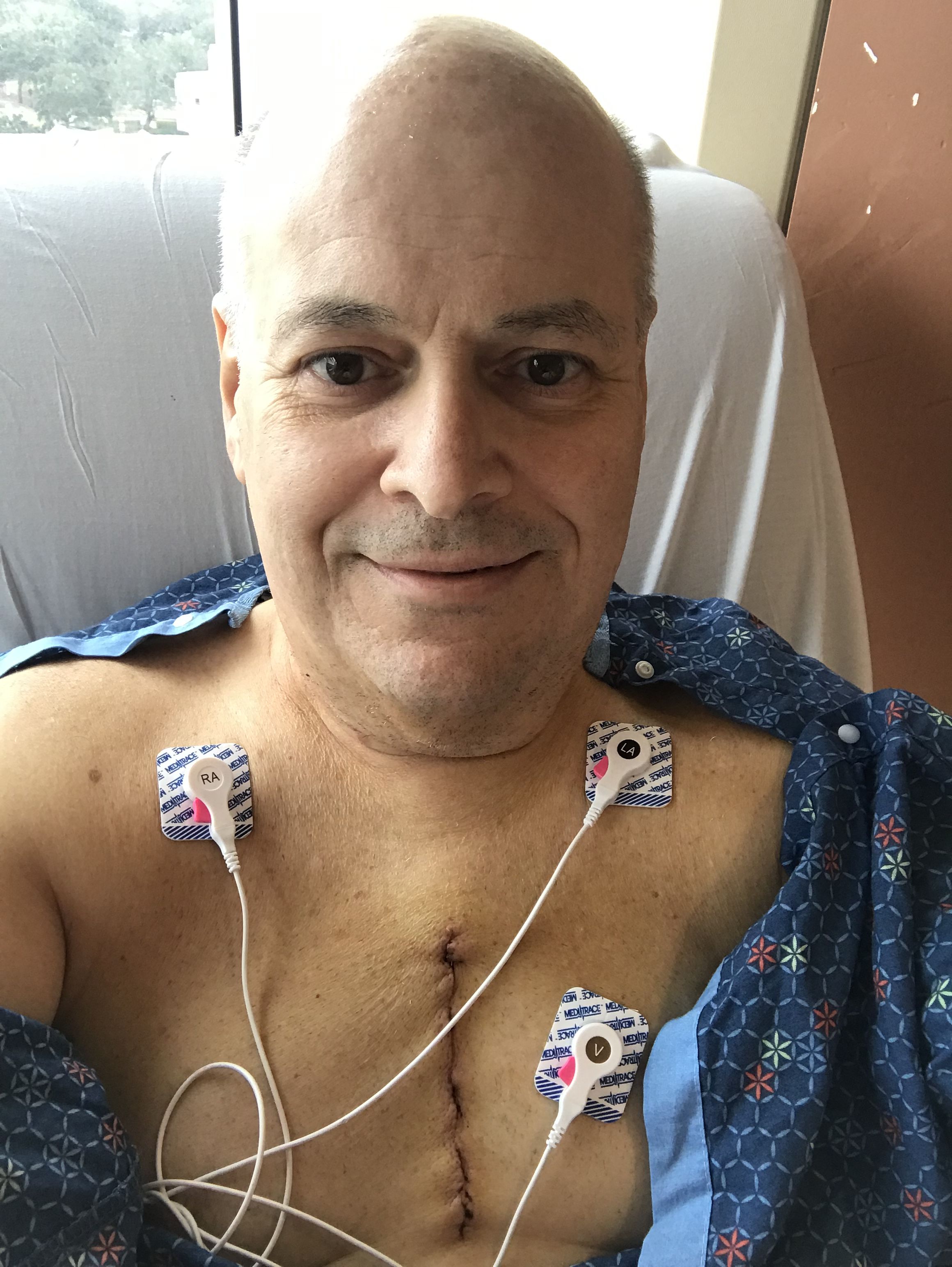 Day 2. The incision into the sternum was not as long as I had expected.
