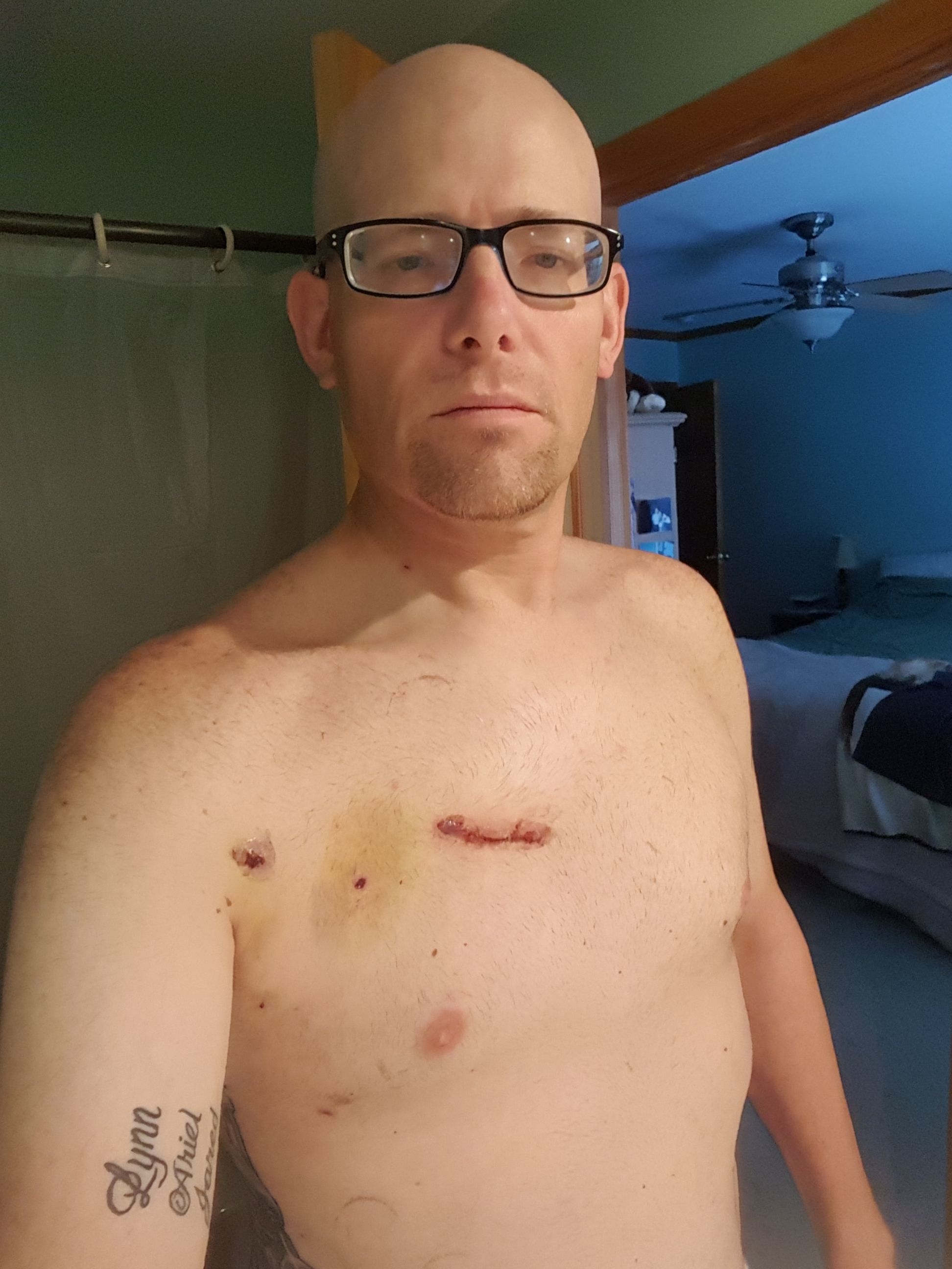 My incision
