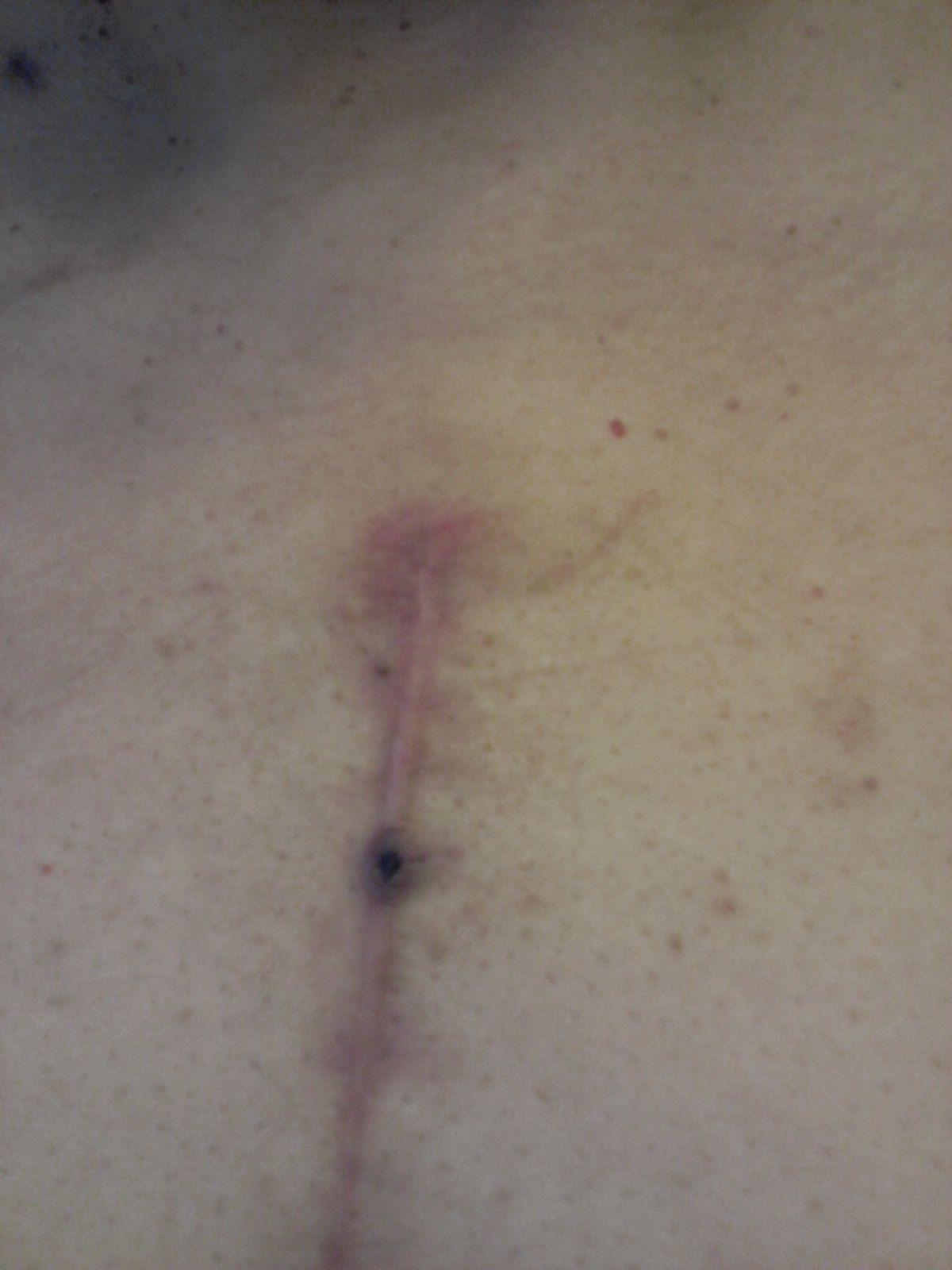 Greetings, I hope everyone is doing well, haven't been here in a while because been busy with work and rehab. But I noticed yesterday morning that there was some discoloration along my incision, here's the pic, it looks like a little scab developed. I'm t