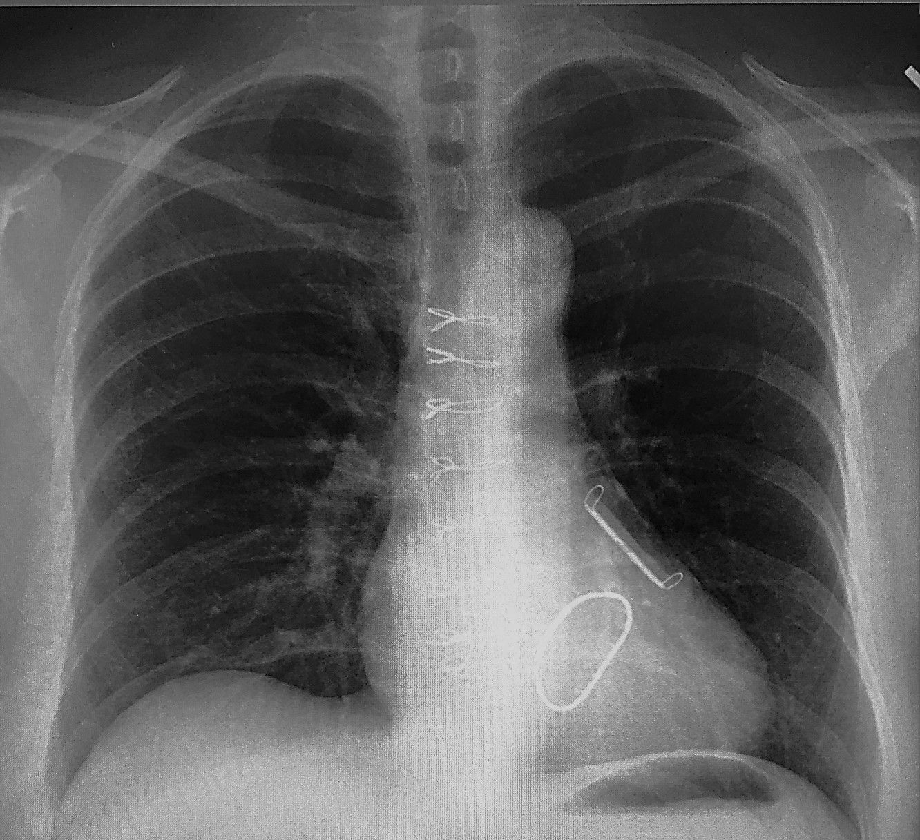 Finally, after 2 years, I got to see a chest x-ray! I wanted to see where the ties were on my sternum, but the ring and atrial appendage clip placement is really interesting!